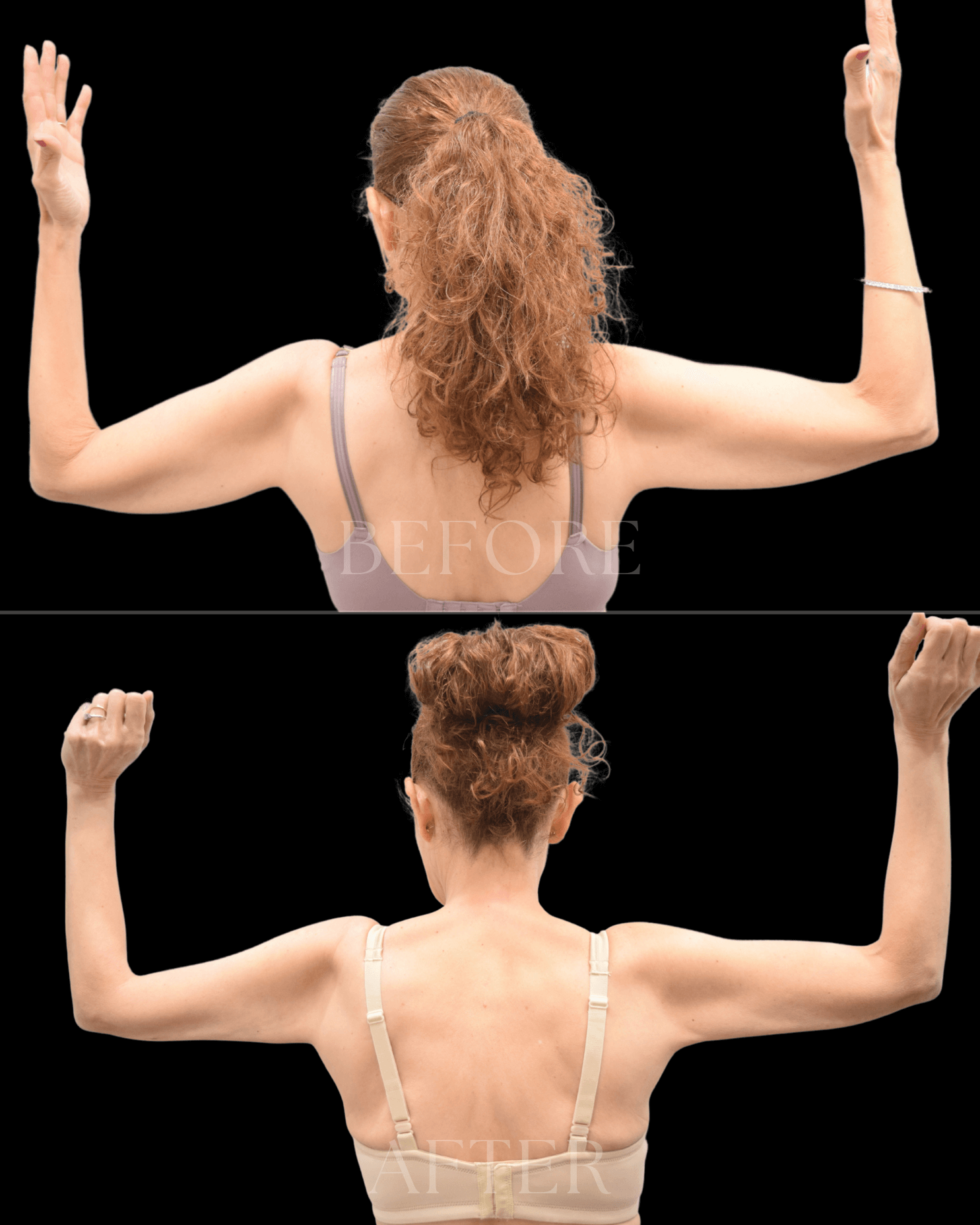 "Before and after images of a woman with arms raised, showing potential results of a cosmetic procedure, with visible differences in arm tone and skin appearance."