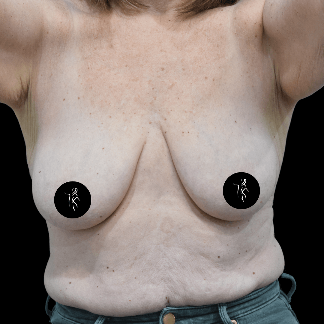 A person with raised arms, focused on the chest area, covered for modesty. The image highlights features for medical or cosmetic analysis.