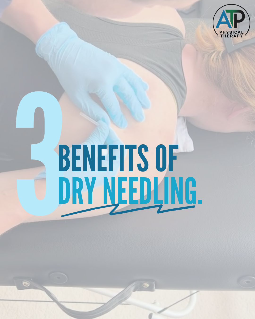 Physical therapist performing dry needling to a patient's shoulder to reduce pain. Overlay title says "3 Benefits of Dry Needling". Dr. Ned Bixby. All Time Performance Physical Therapy serving Fuquay Varina, Holly Springs, Apex, Cary, & Garner