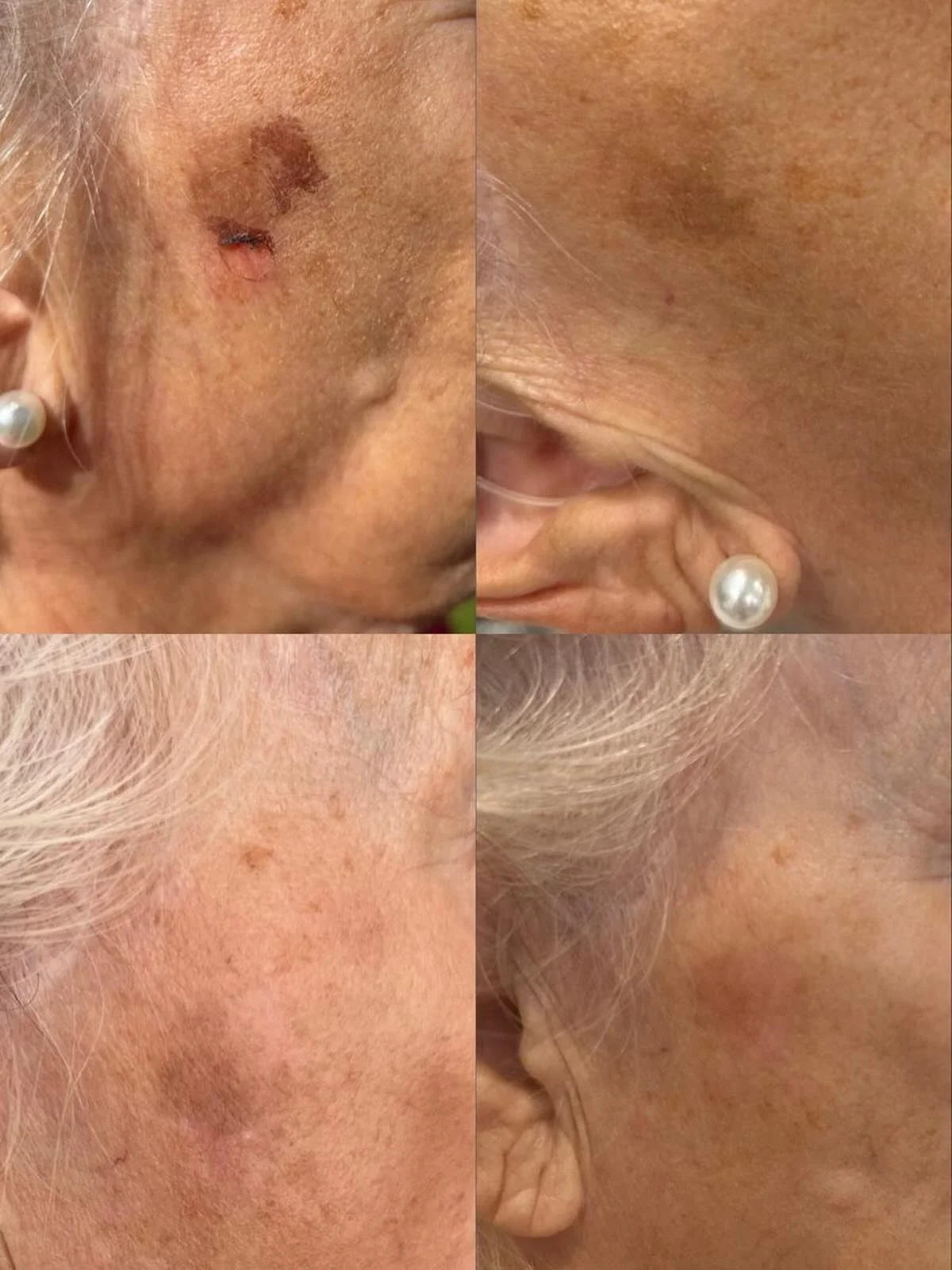 Sun damage doesn&rsquo;t have to be permanent ☀️✨

This transformation was achieved using CryoPen to safely and precisely target a stubborn sun spot. Results shown after just 2 treatments, allowing the skin to naturally heal and reveal a clearer, mor