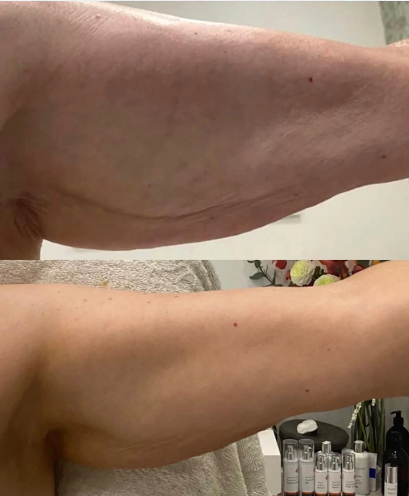 ✨ New treatment taking The LHB by storm ✨

These results speak for themselves 👀

Using radiofrequency technology, this non-invasive treatment gently heats the deeper layers of the skin to support collagen contraction and stimulate new collagen produ