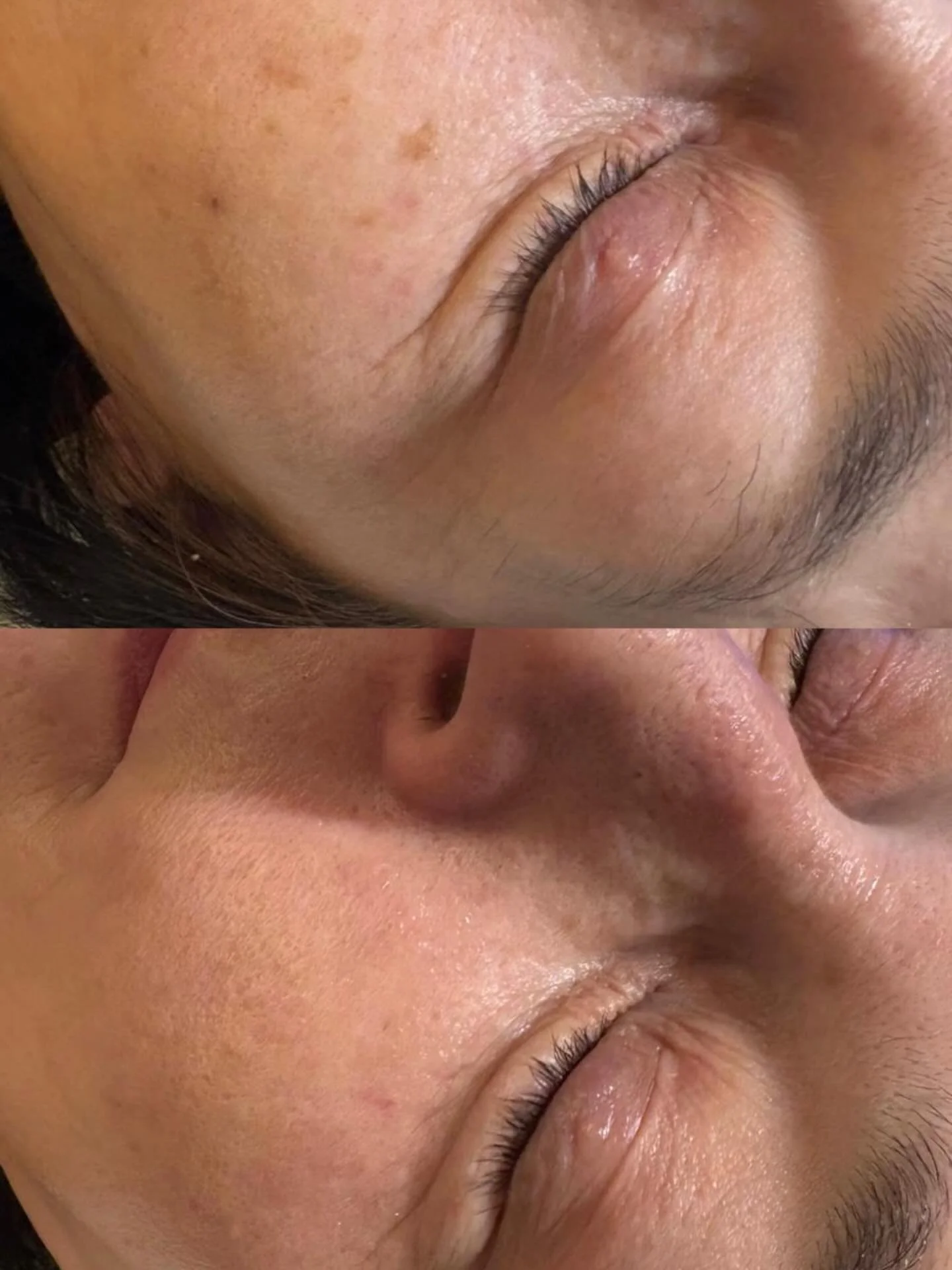 ✨ Just one CryoPen treatment

A quick, targeted treatment to safely remove unwanted sun spots and superficial pigmentation using precise freezing technology. The treated area naturally sheds over the following days, revealing clearer, more even-looki