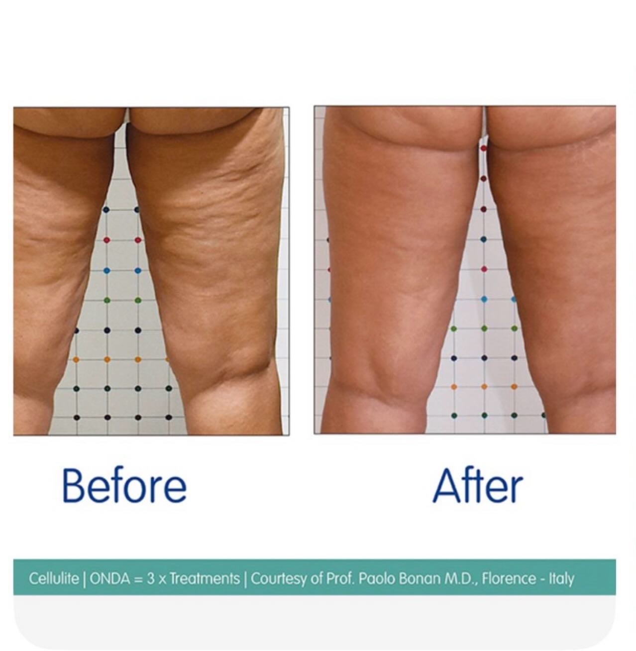 🍑 Radio Frequency for Bum &amp; Legs 🍑

Summer bodies are made in spring&hellip; and this is one of our favourite treatments to help get you there 👀✨

Radio Frequency (RF) uses controlled heat to stimulate collagen and elastin deep within the skin