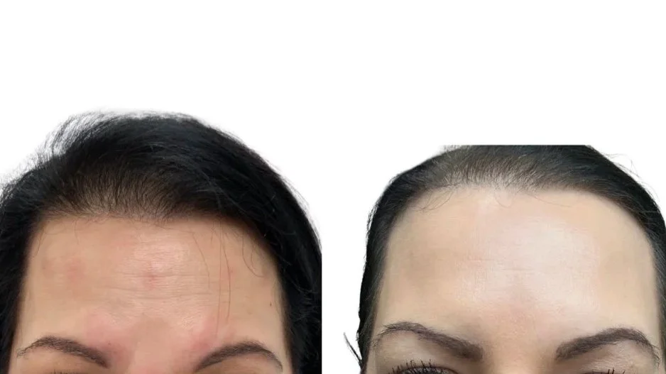 Before and after Dysport treatment forehead lines.