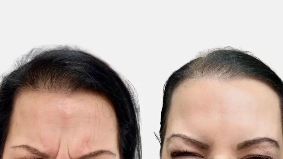 Before and after Dysport treatment brow area.