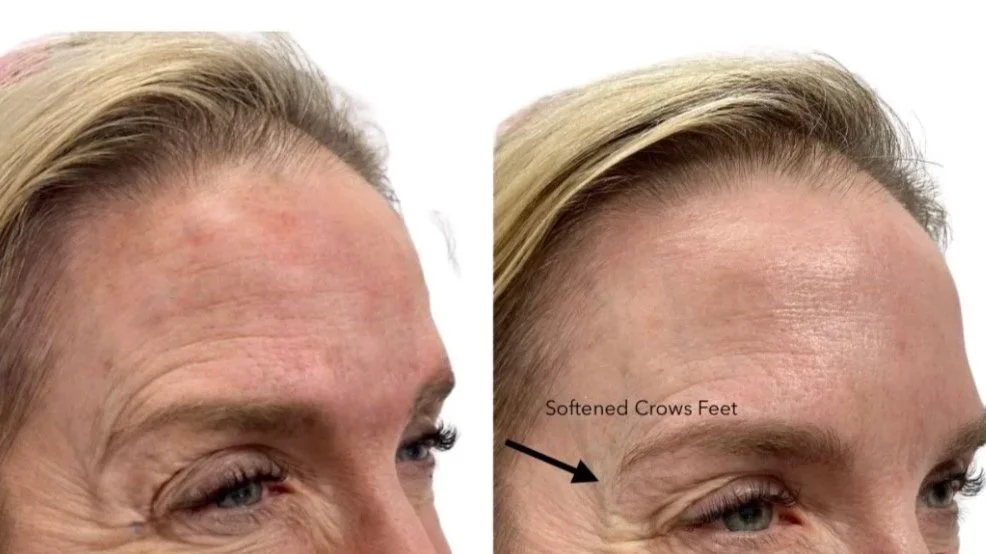 Before and after Dysport treatment crows feet.