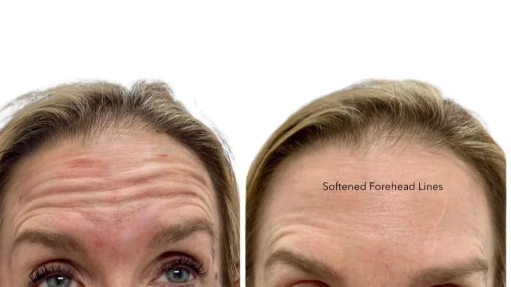 Before and after Dysport treatment forehead lines.
