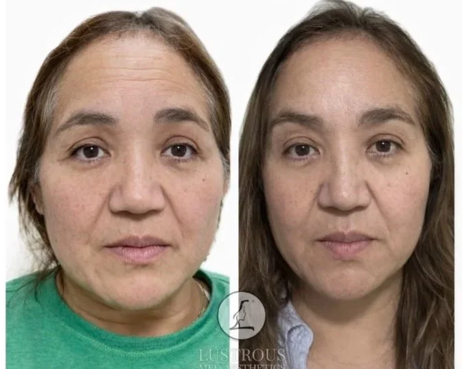  Before and After Xeomin treatment to forehead, crows feet, and brow area.
