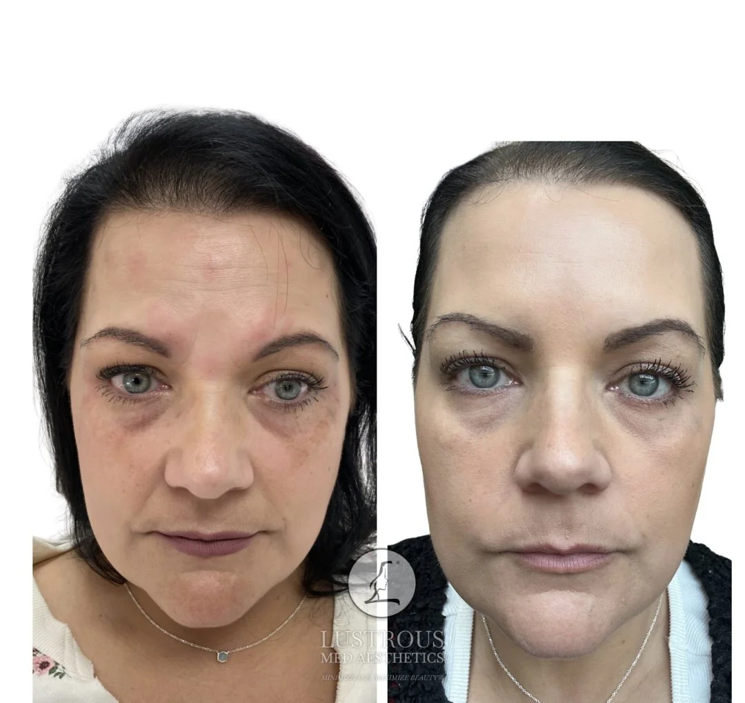 Before and After Dysport: Smooth, refreshed, natural looking forehead results 