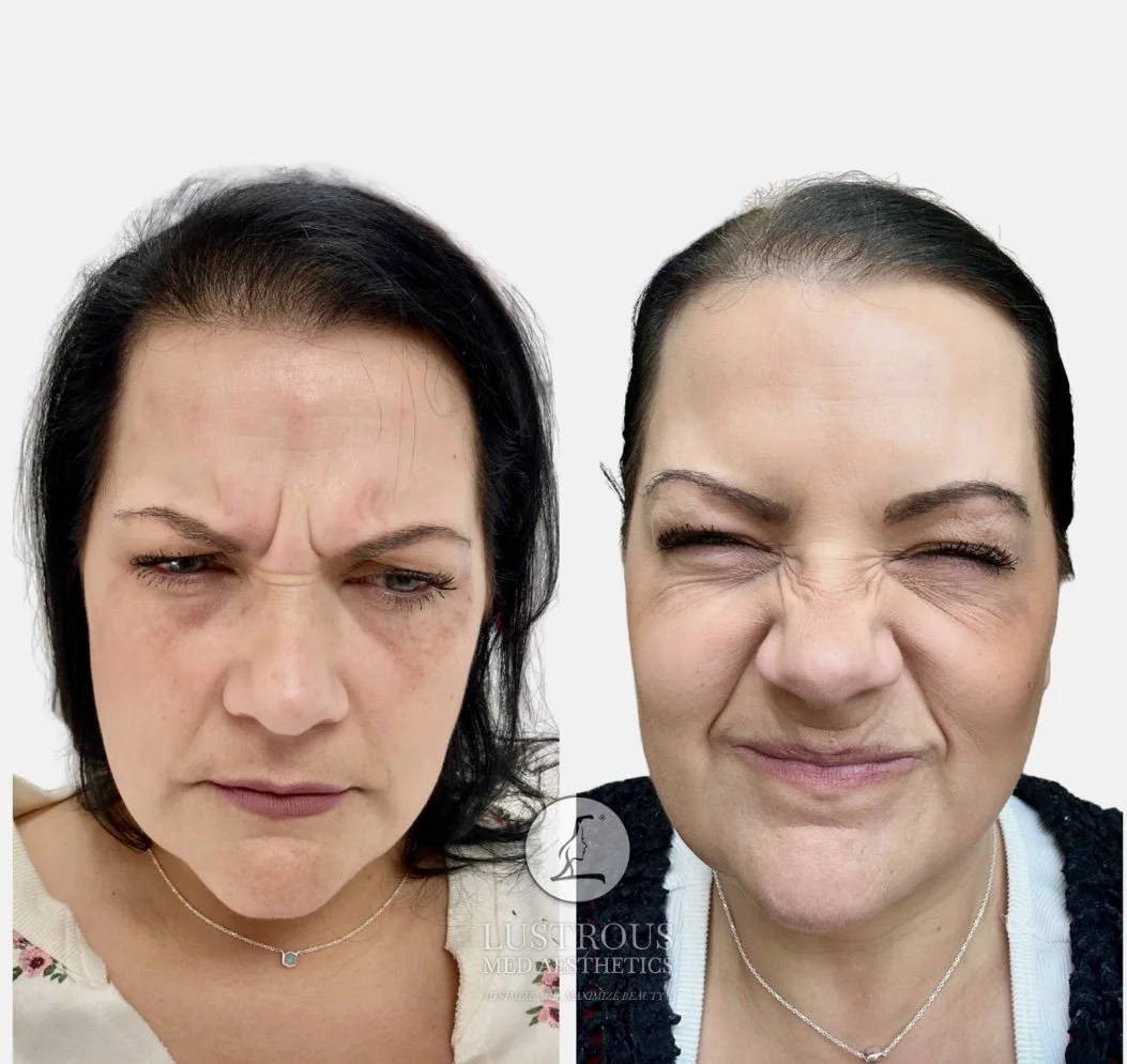Before and After Dysport: Smooth, refreshed, natural looking brow results 