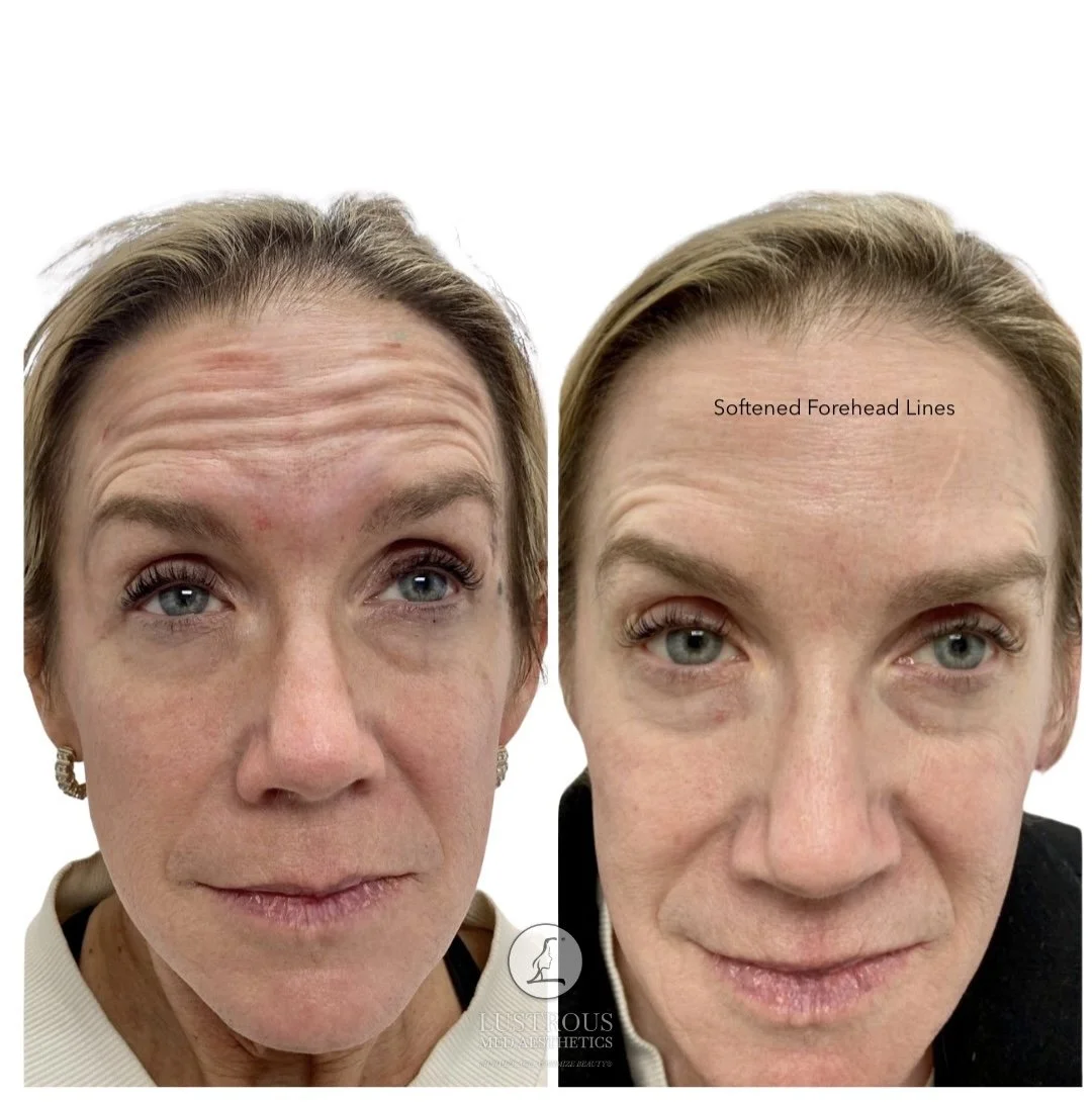 Before and After Dysport: Smoothed refreshed forehead with natural looking results 