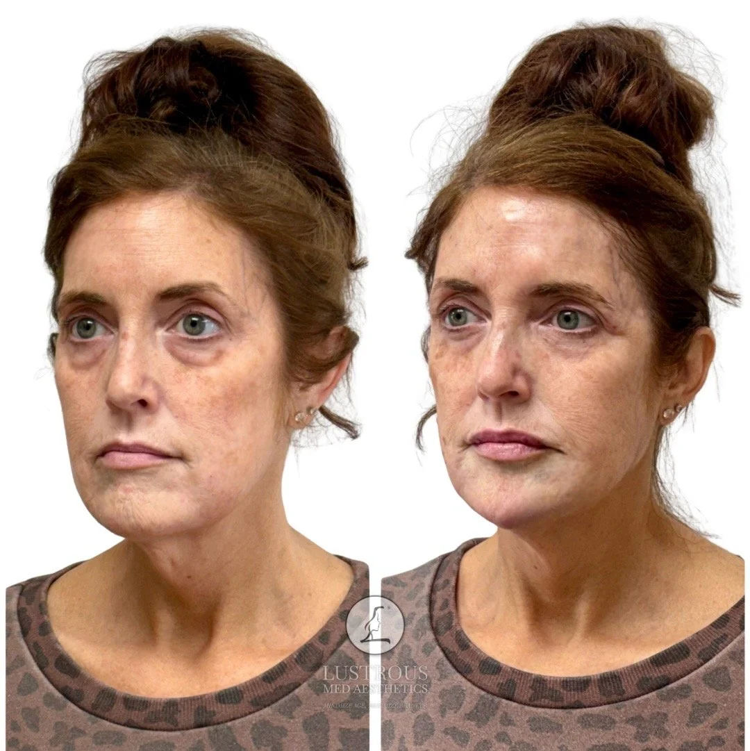 Dermal filler treatment, improved chin projection and contour creating smother transition through the lower face for a more balanced, harmonious profile. 