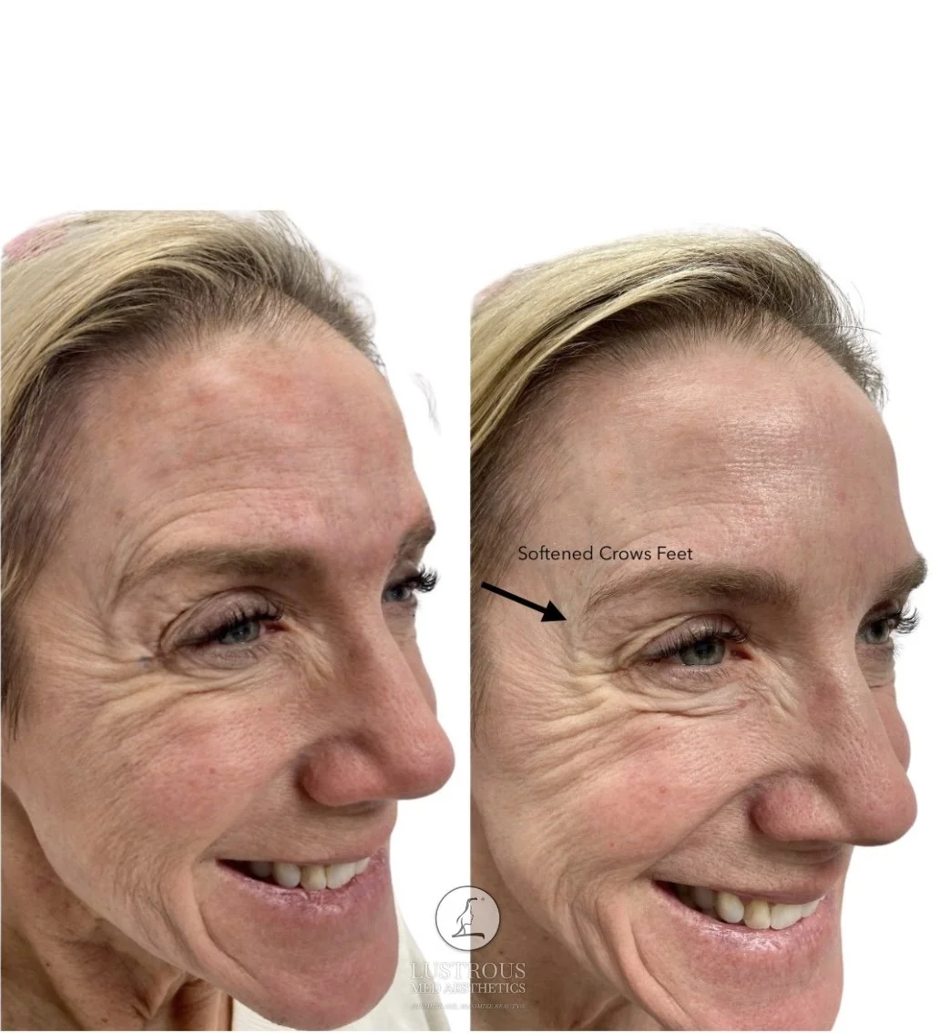 Before and After Dysport: Softened crow's feet with smooth natural looking results 