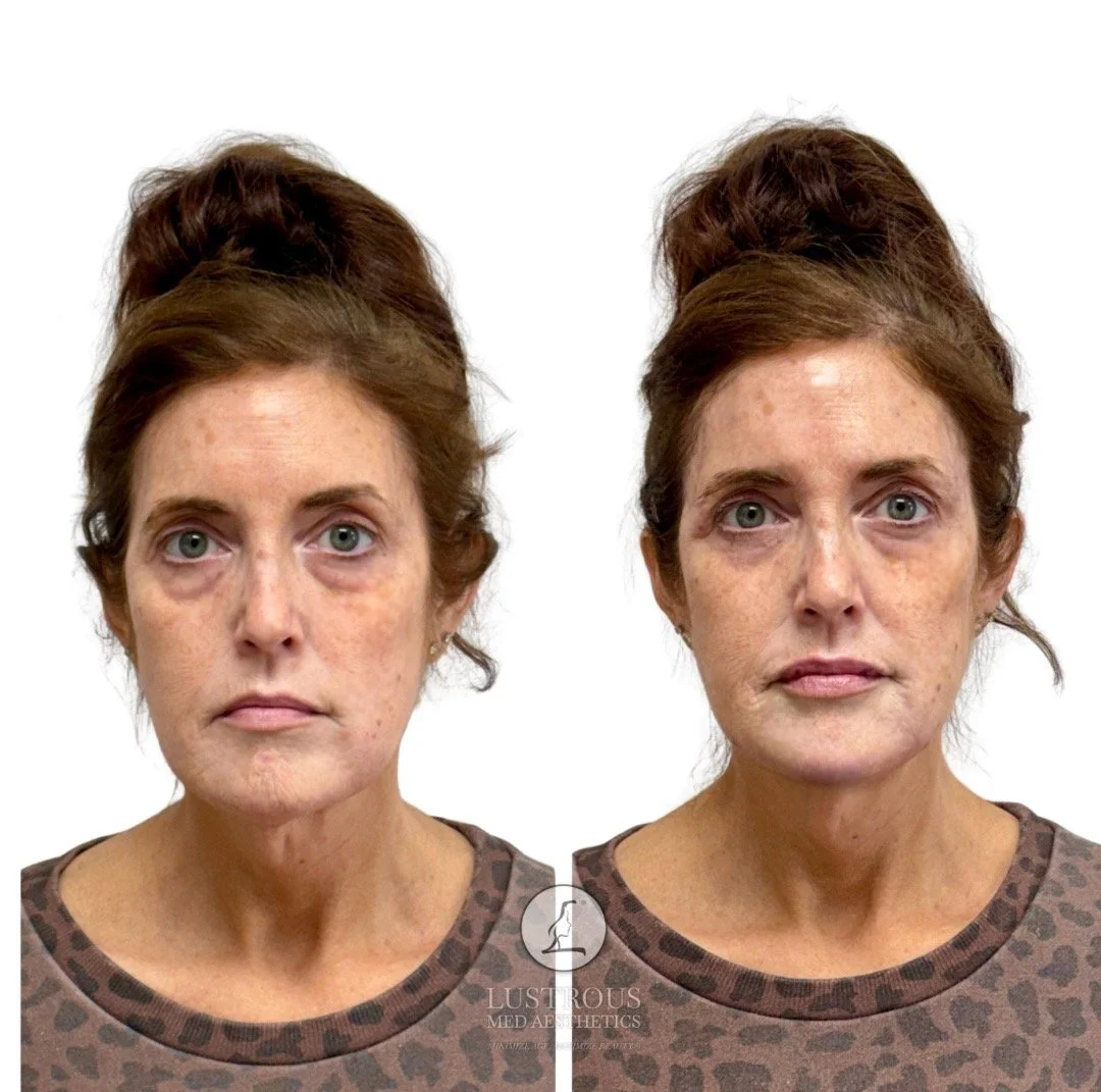 Temple filler restored volume and added support to the upper face, creating a smoother transition into the eye area and creating a more open, refreshed appearance., without filler being placed around the eyes. 