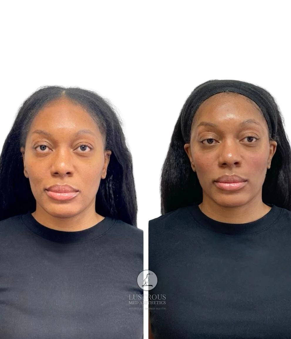 Before & After Facial balancing upper and mid-face: Restored value through the temples and cheeks form a more lifted contoured facial appeared  