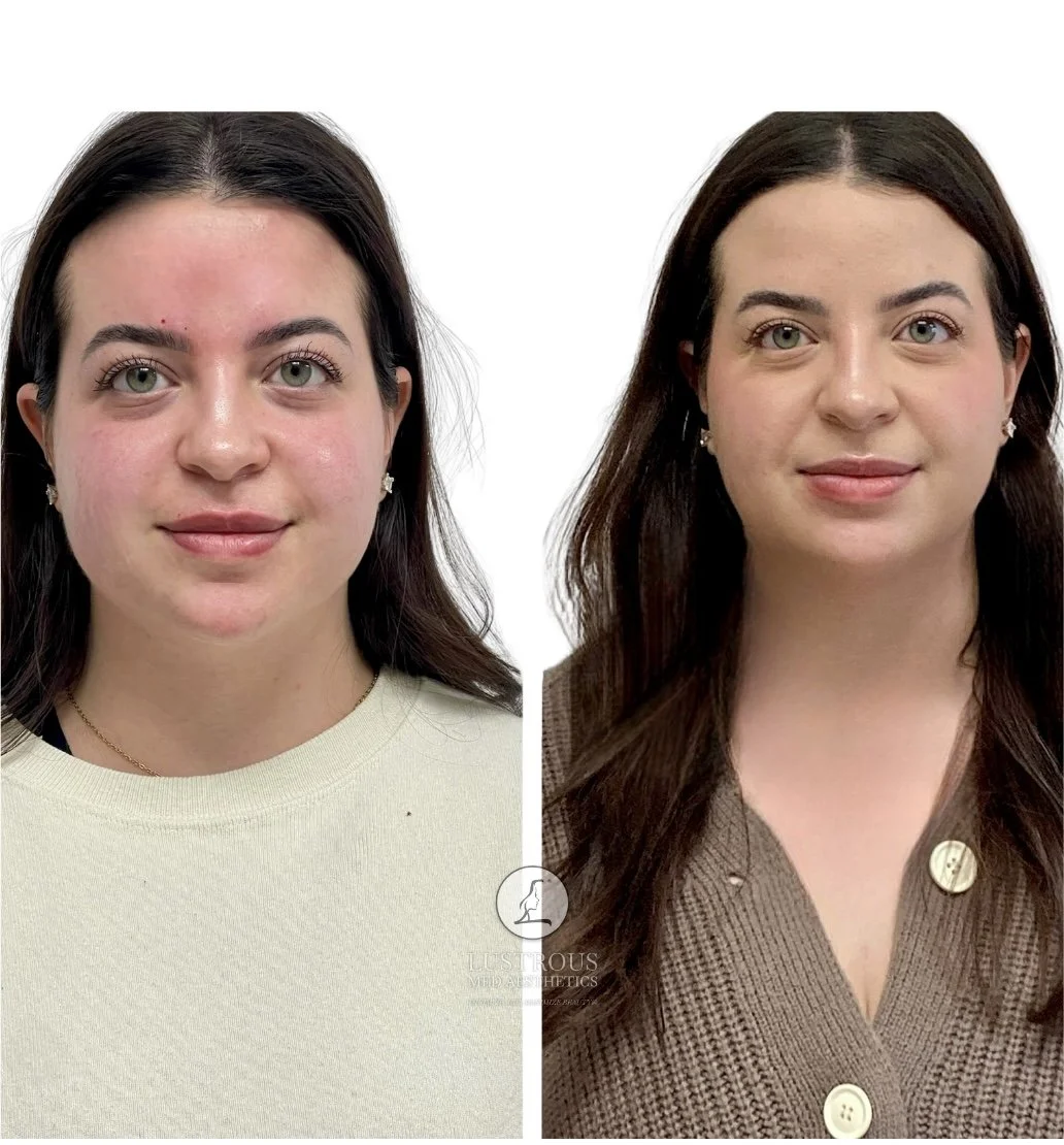 Before & After Dysport to the masseter muscles (jaw muscles) visible facial slimming and a softer, more contoured jawline.  