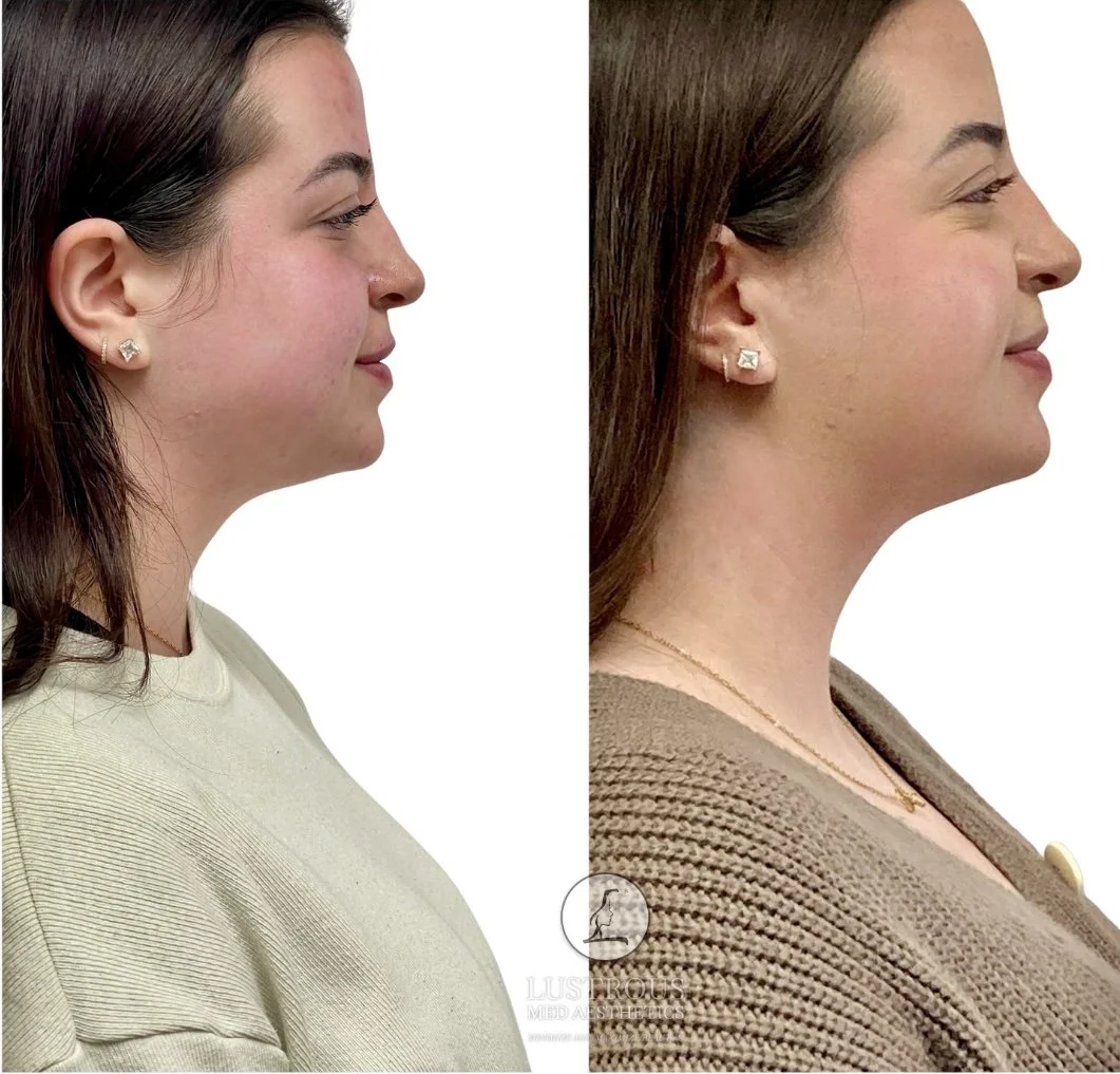 Before & After Dysport to the masseter muscles (jaw muscles) visible facial slimming and a softer, more contoured jawline.  