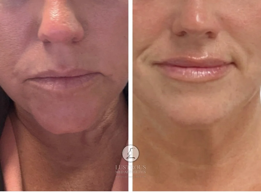 Before & After Lip Filler: Lip filler results after 2 sessions restored hydration, improved definition and natural looking projection, 