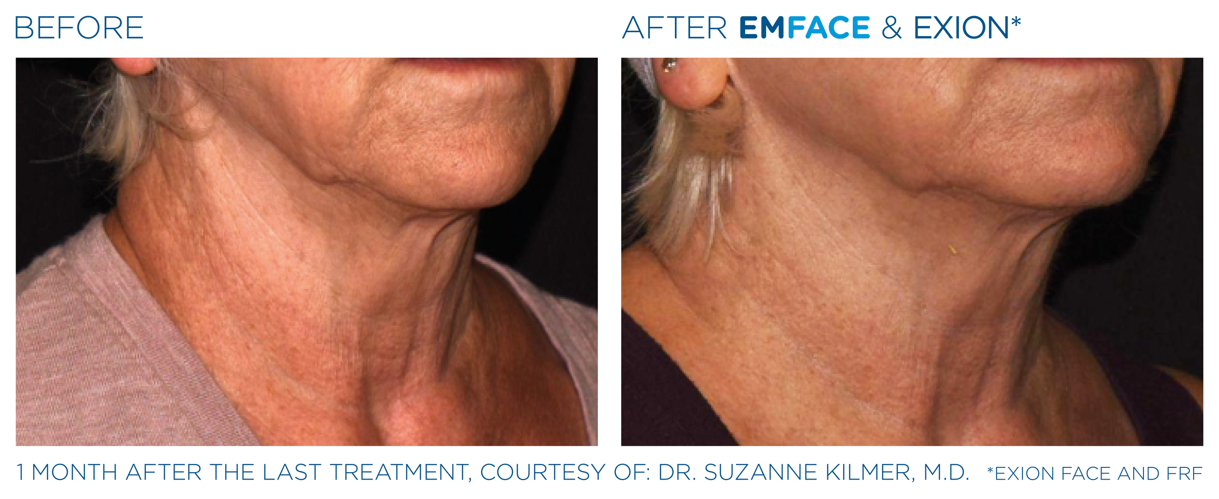 Emface + Exion Chin and Neck_.png