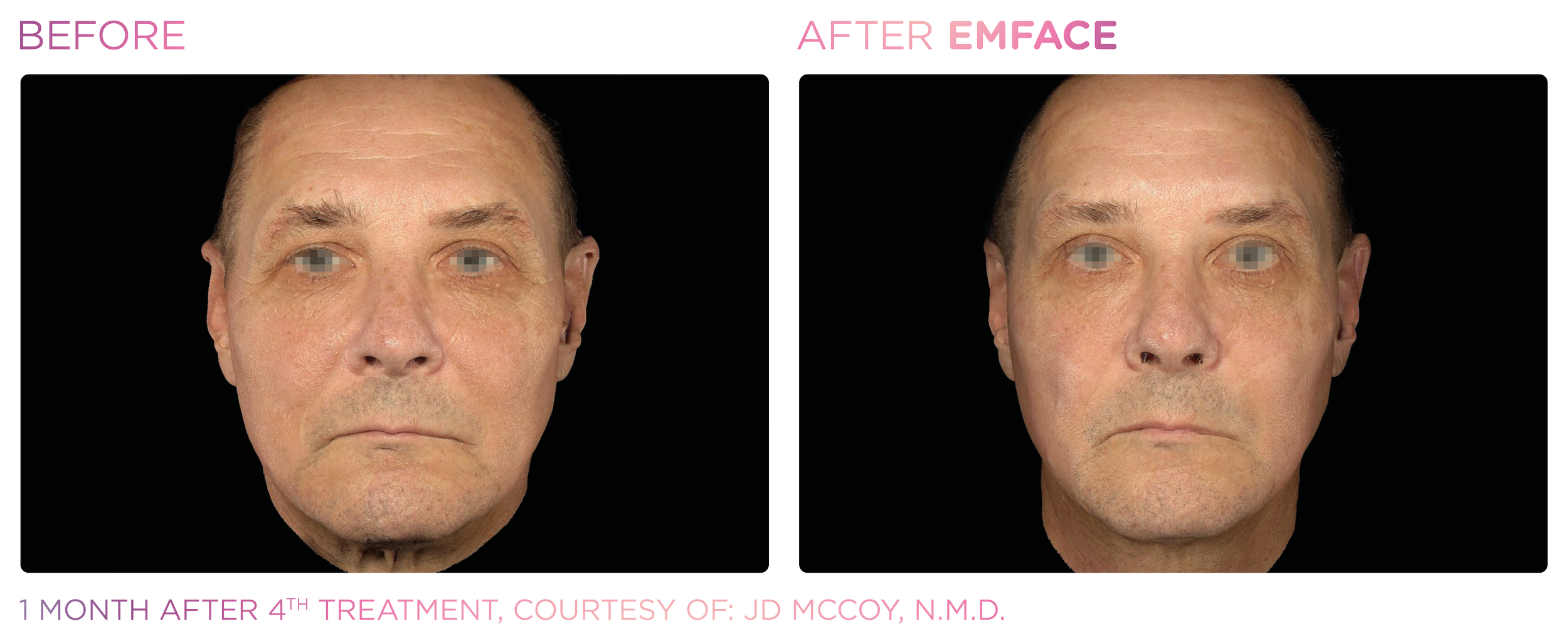 Emface Before and After Male_.png