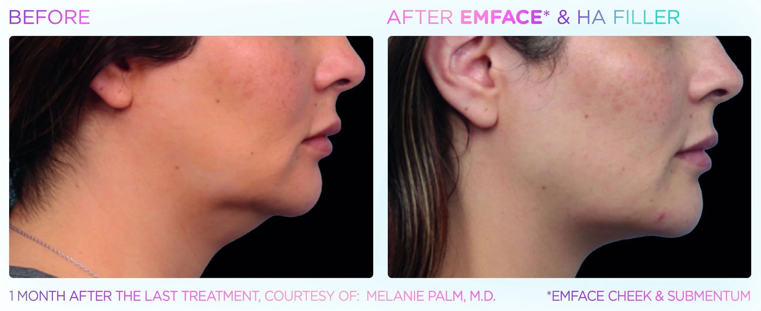 Emface Cheek and Chin Before and After Female_.jpg