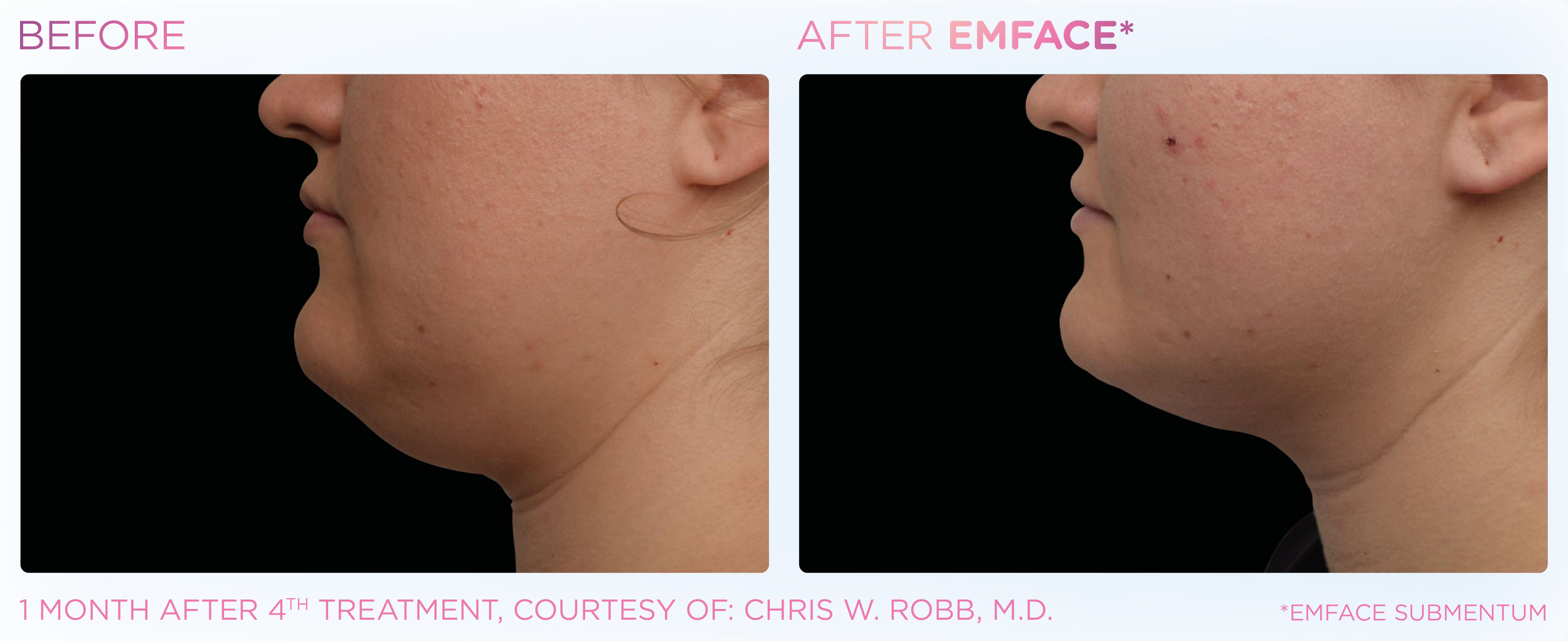 Emface Chin Before and After_.png