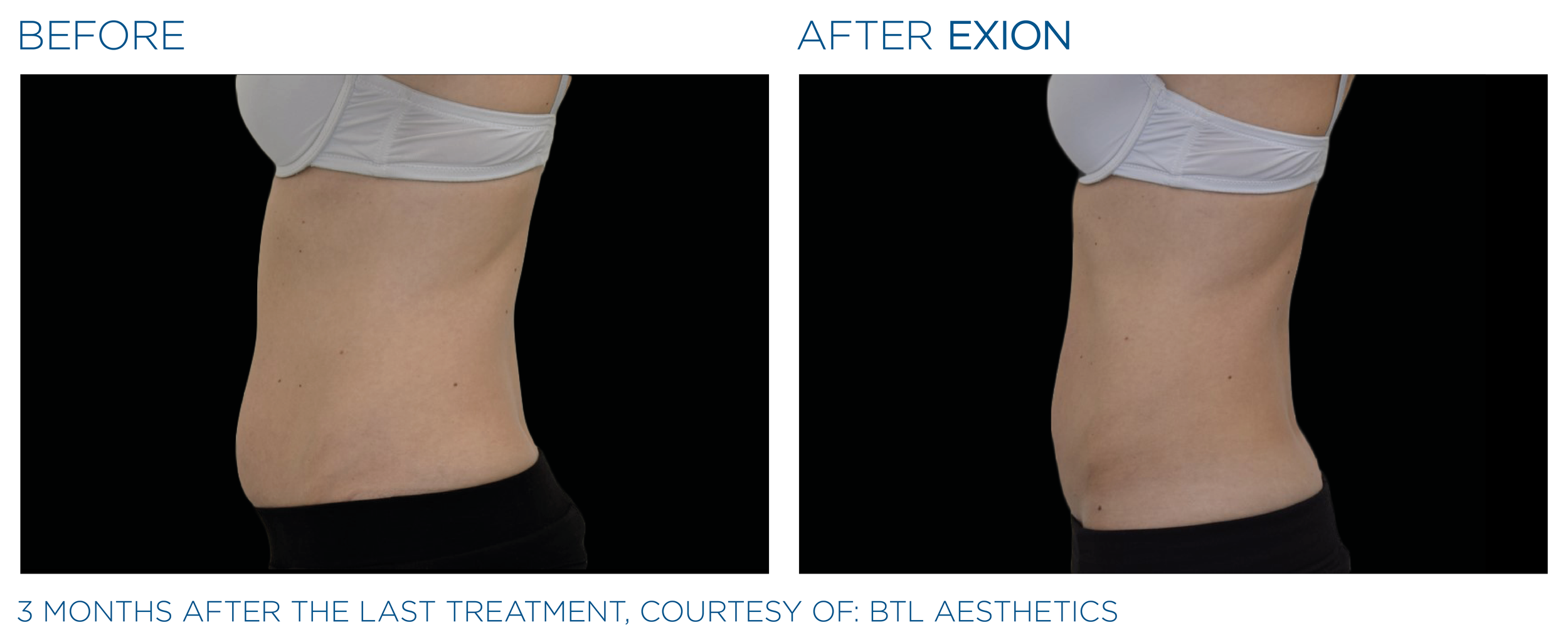 Exion Body Applicator Abd Side View Female_.png