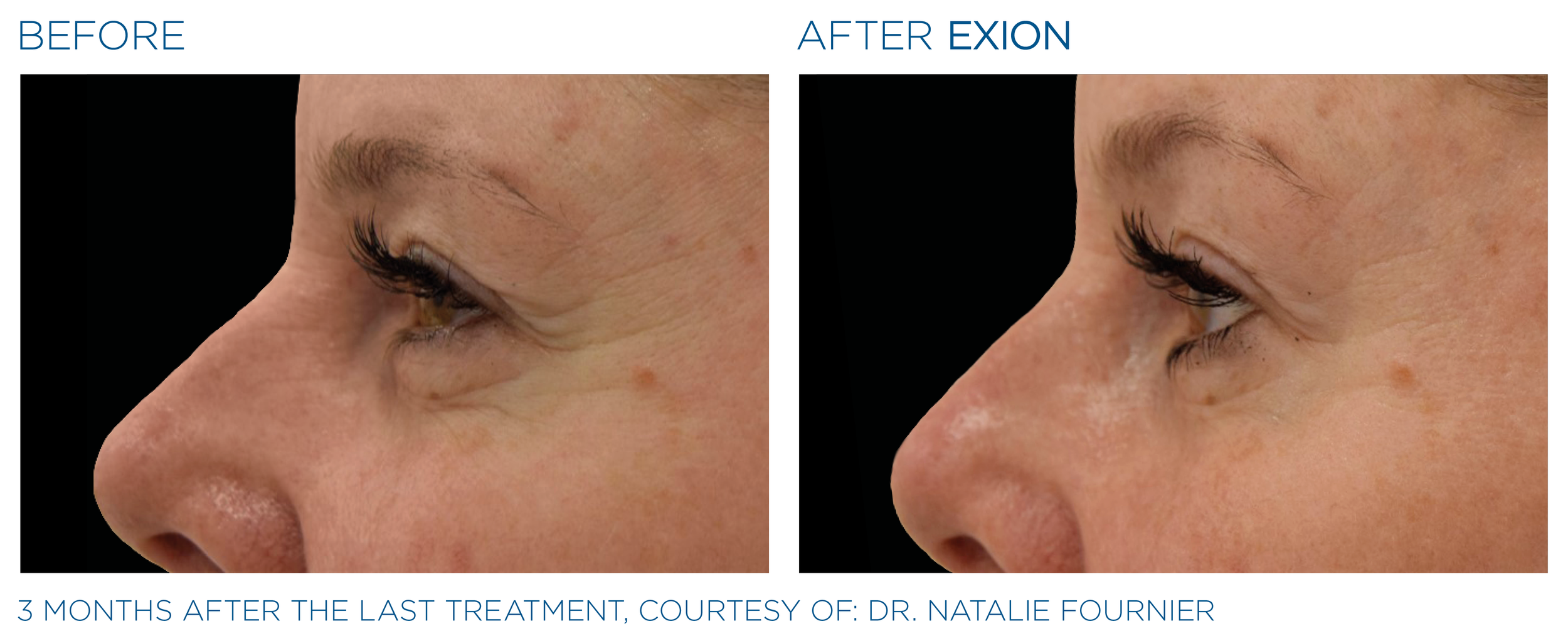 Exion Eyes Before and After 2.png