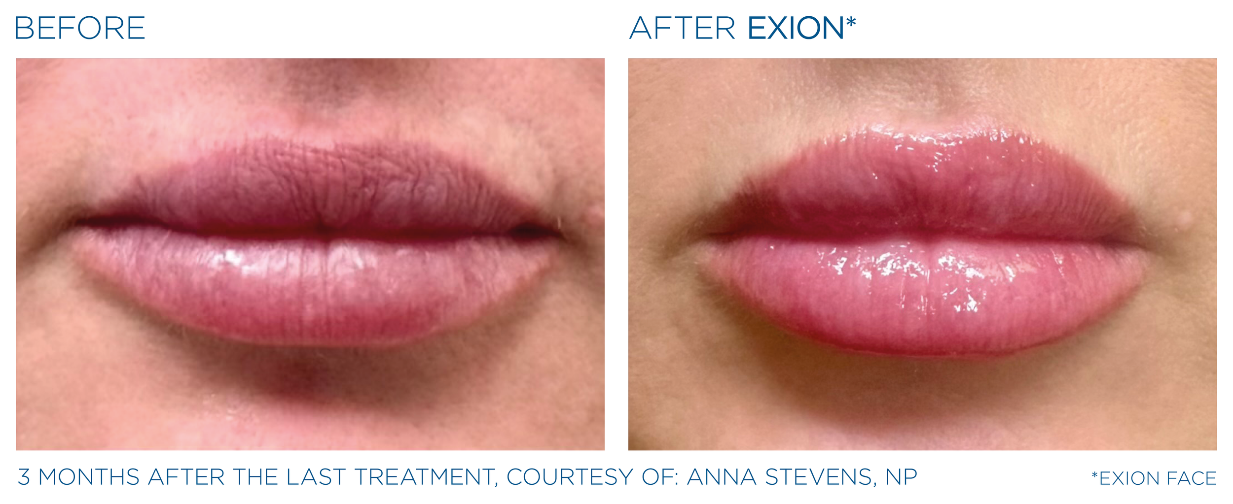 Exion Lips Before and After_.png