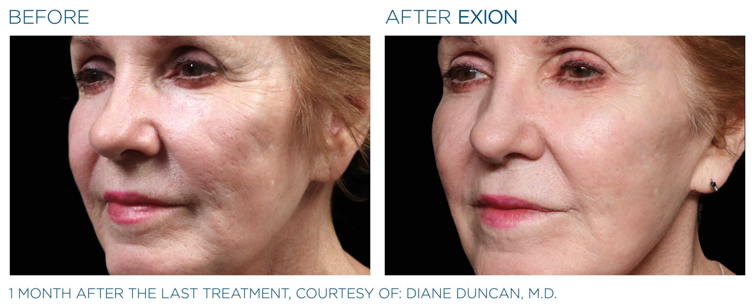 Exion Face Applicator Cheek Before and After_.png