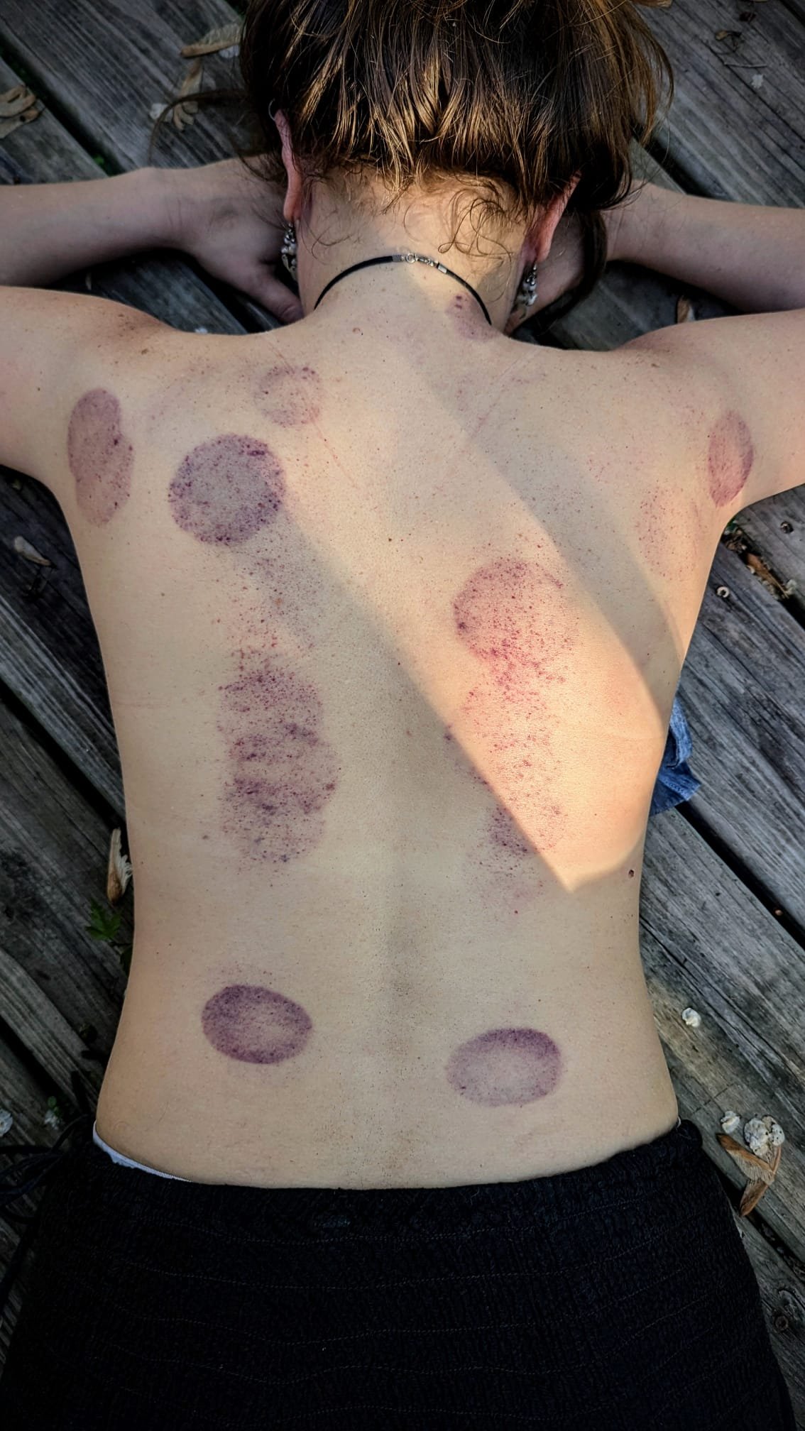 Releasing trauma through fire cupping
