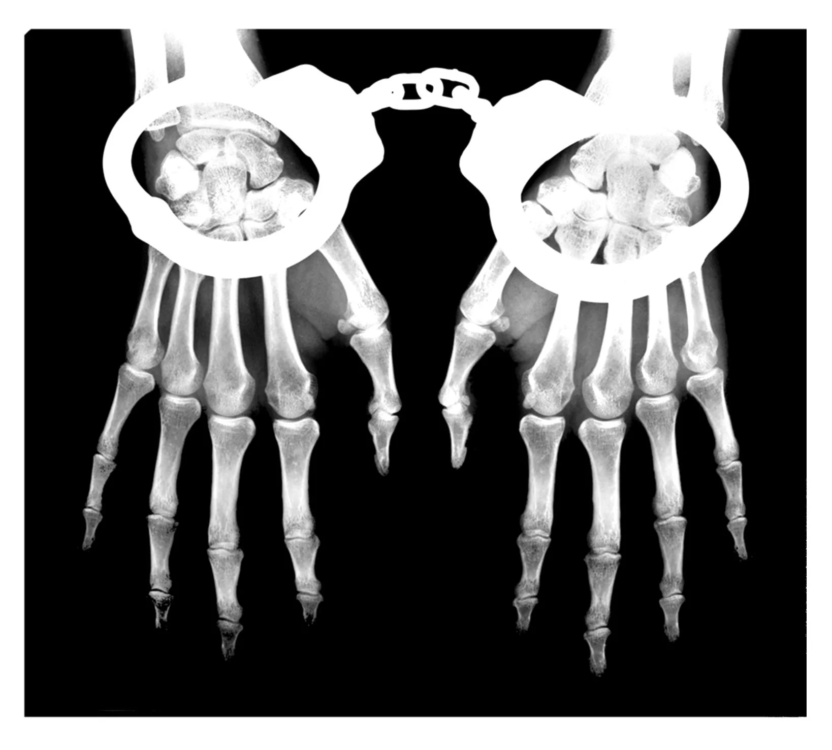 X-ray image of two human skeletons with their hands raised and back-to-back, showing skulls, rib cages, and finger bones.