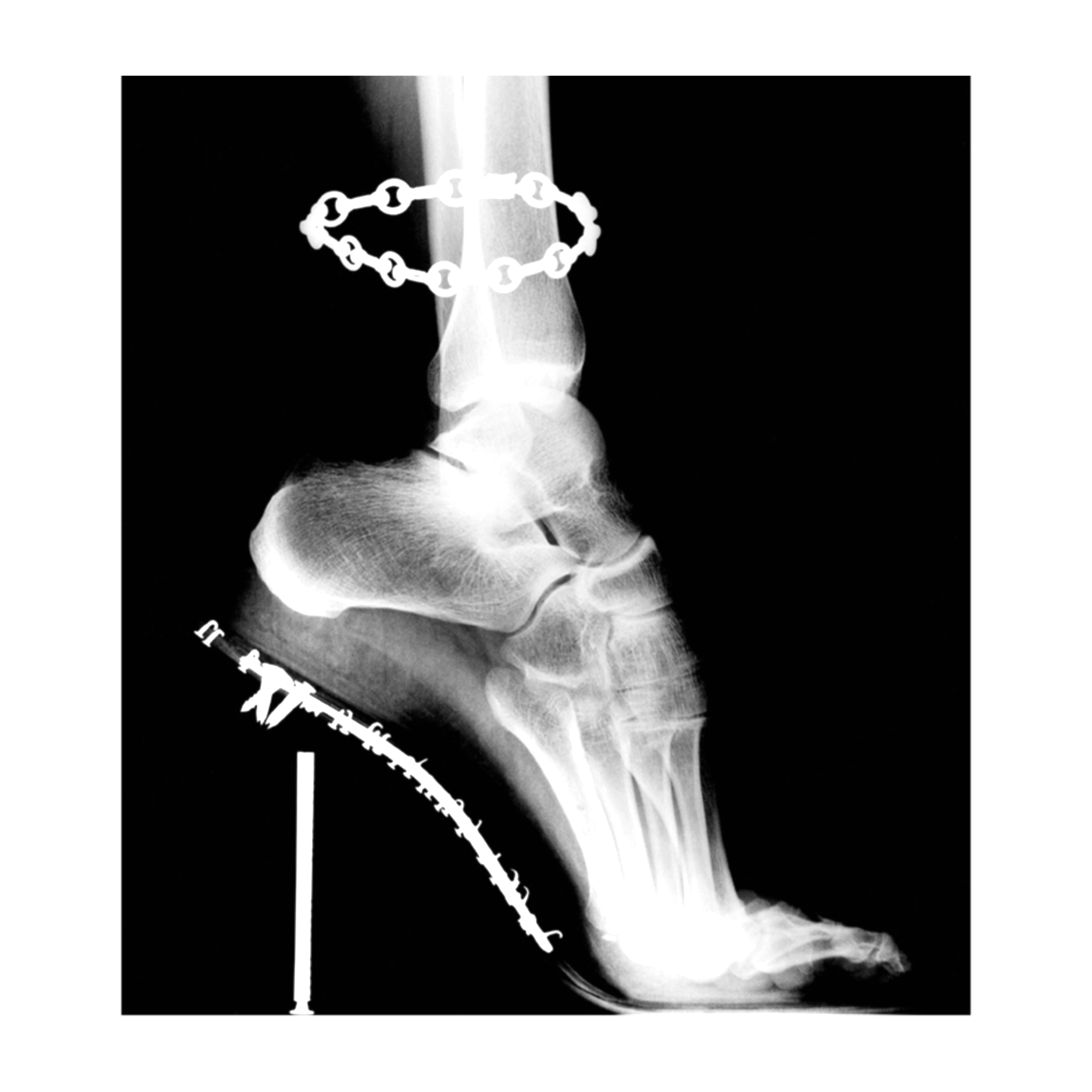 X-ray image of a foot with two metal medical devices, one on the ankle and one on the heel.