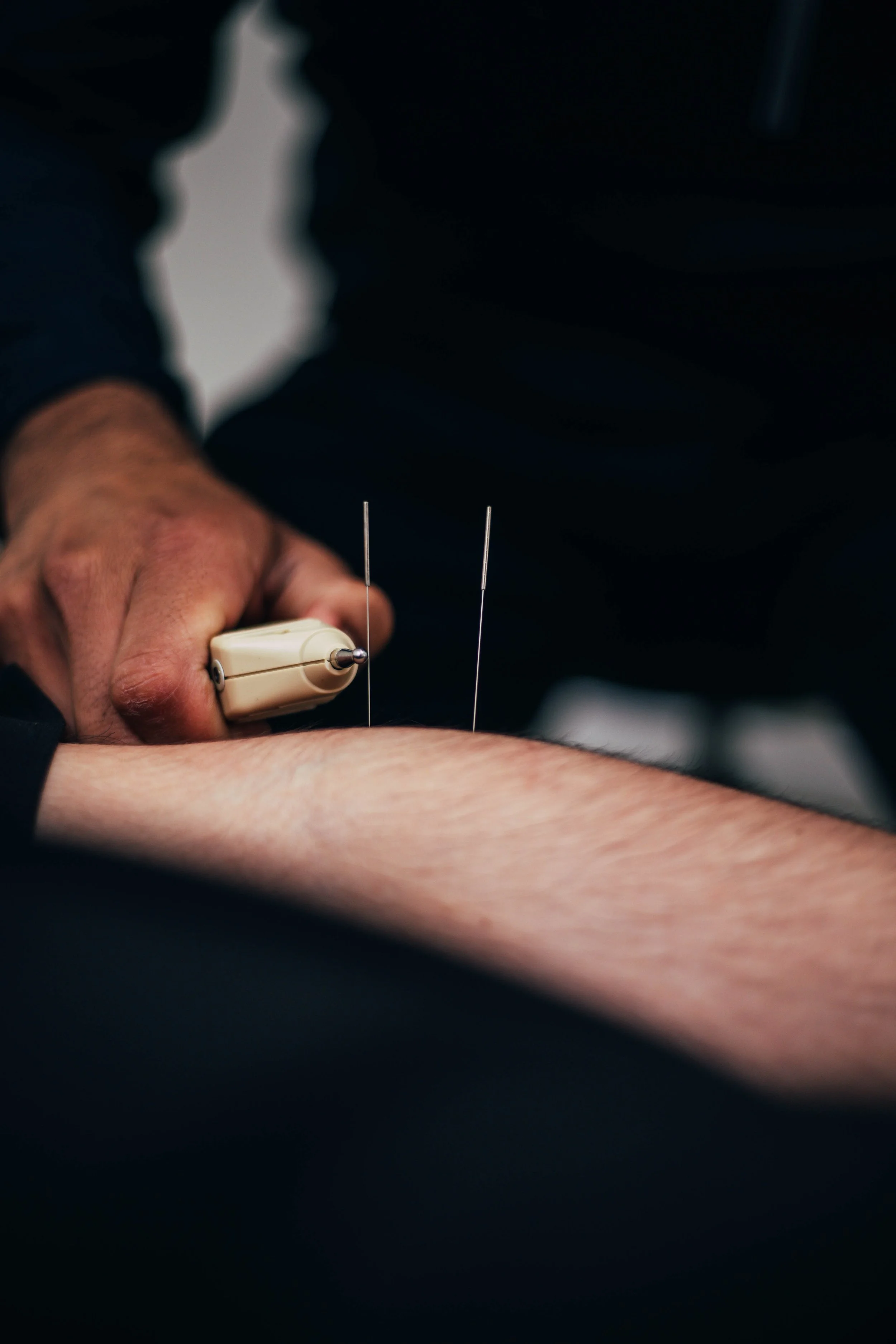 Brampton Acupuncturist Treating a Forearm Injury
