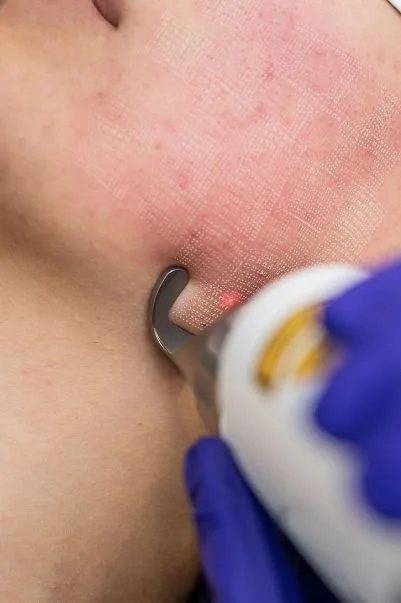 Un professionnel effectue une procédure laser sur la peau du visage, probablement un traitement dermatologique.