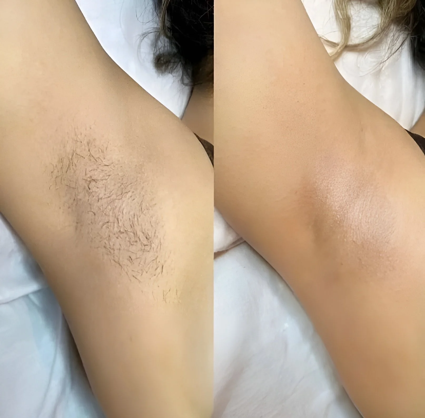 Photo de deux jambes, une avec poils et l'autre rasée, allongées sur un lit avec des draps blancs.