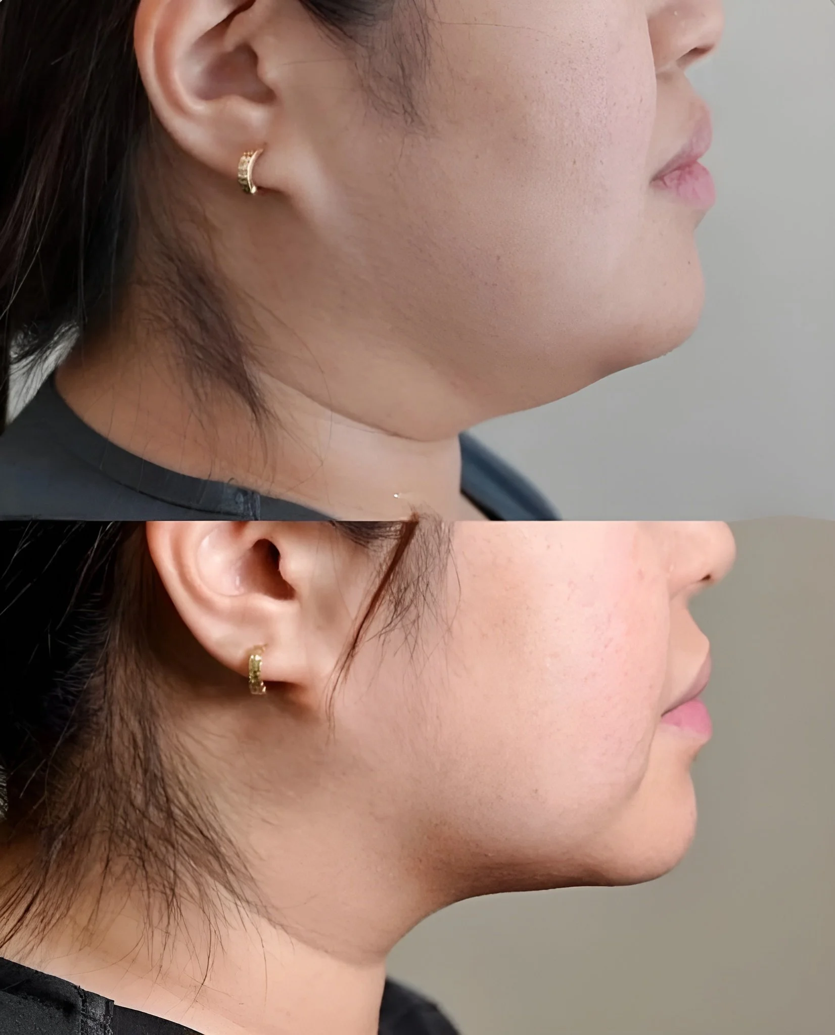 Comparaison avant et après d'une réduction du double menton avec des deux côtés de la tête montrant un changement notable dans la zone du menton.