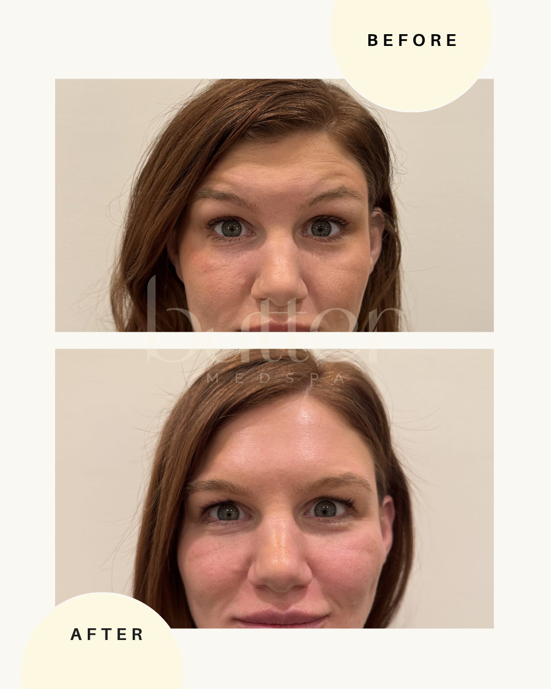 Botox wrinkle relaxer treatment paramus NJ medspa