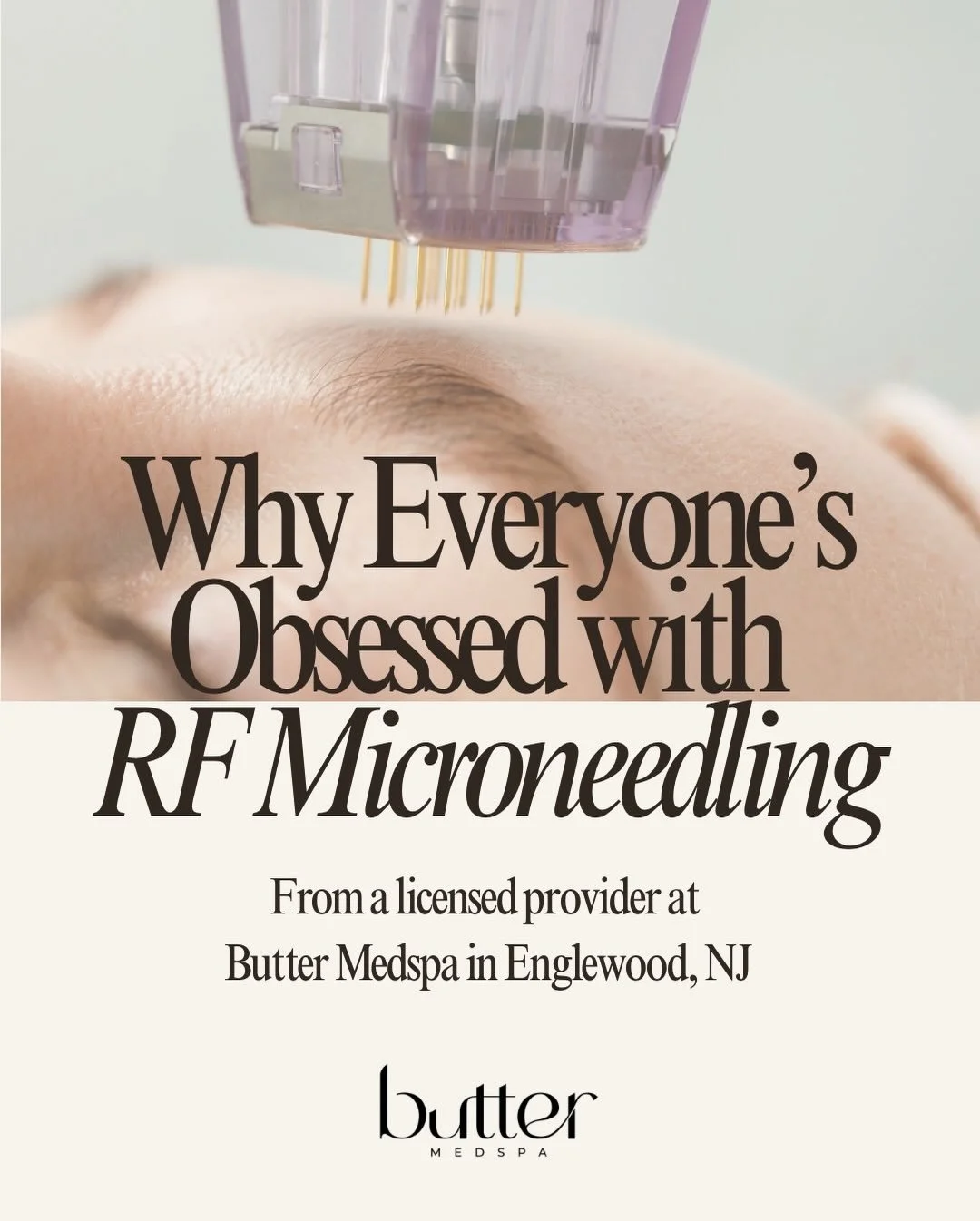 Have you ever considered RF Microneedling?