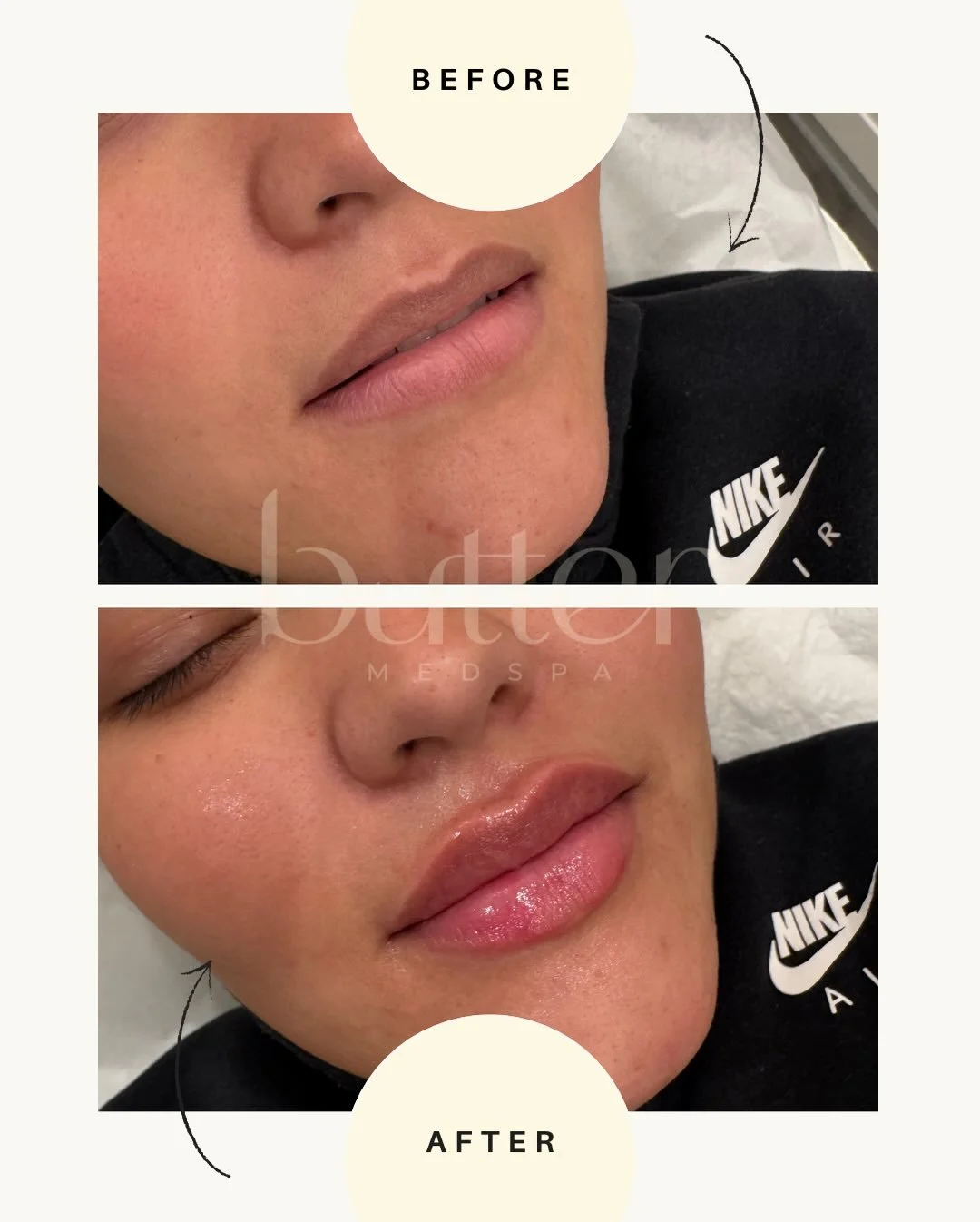 Your lips, but Butter. Swipe to see three different lip before &amp; afters. 

💛 Client 1:
Wanted enhanced volume while still keeping things natural.
We used 1 ML (Full Butter Kiss) to add fullness and shape without overdoing it.

💛 Client 2:
Looki