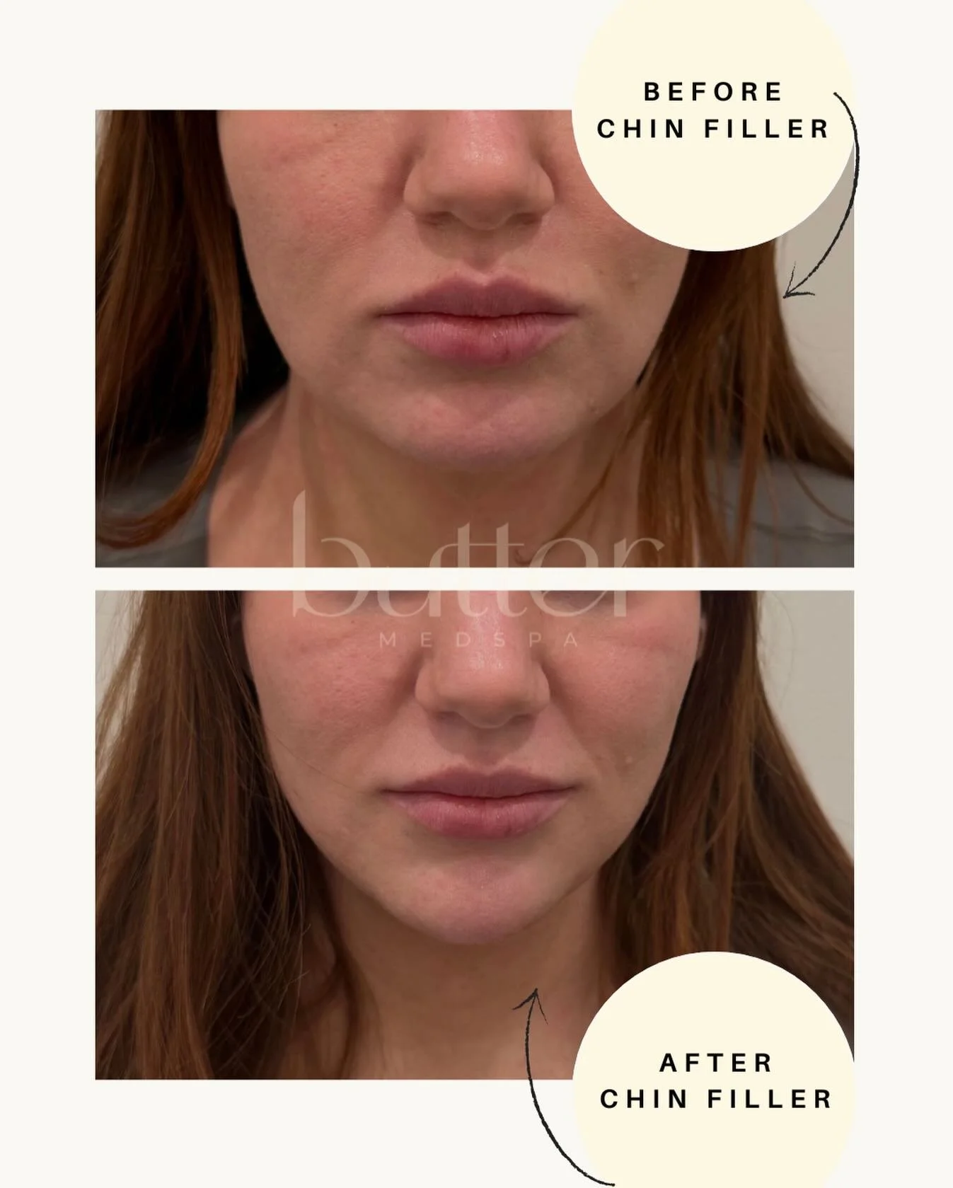 This transformation was done using 1ML of chin filler to enhance projection, improve profile harmony, and create a softer, more feminine balance to the face. 

Enjoy promotional pricing when you book your facial balancing appointment during our Valen