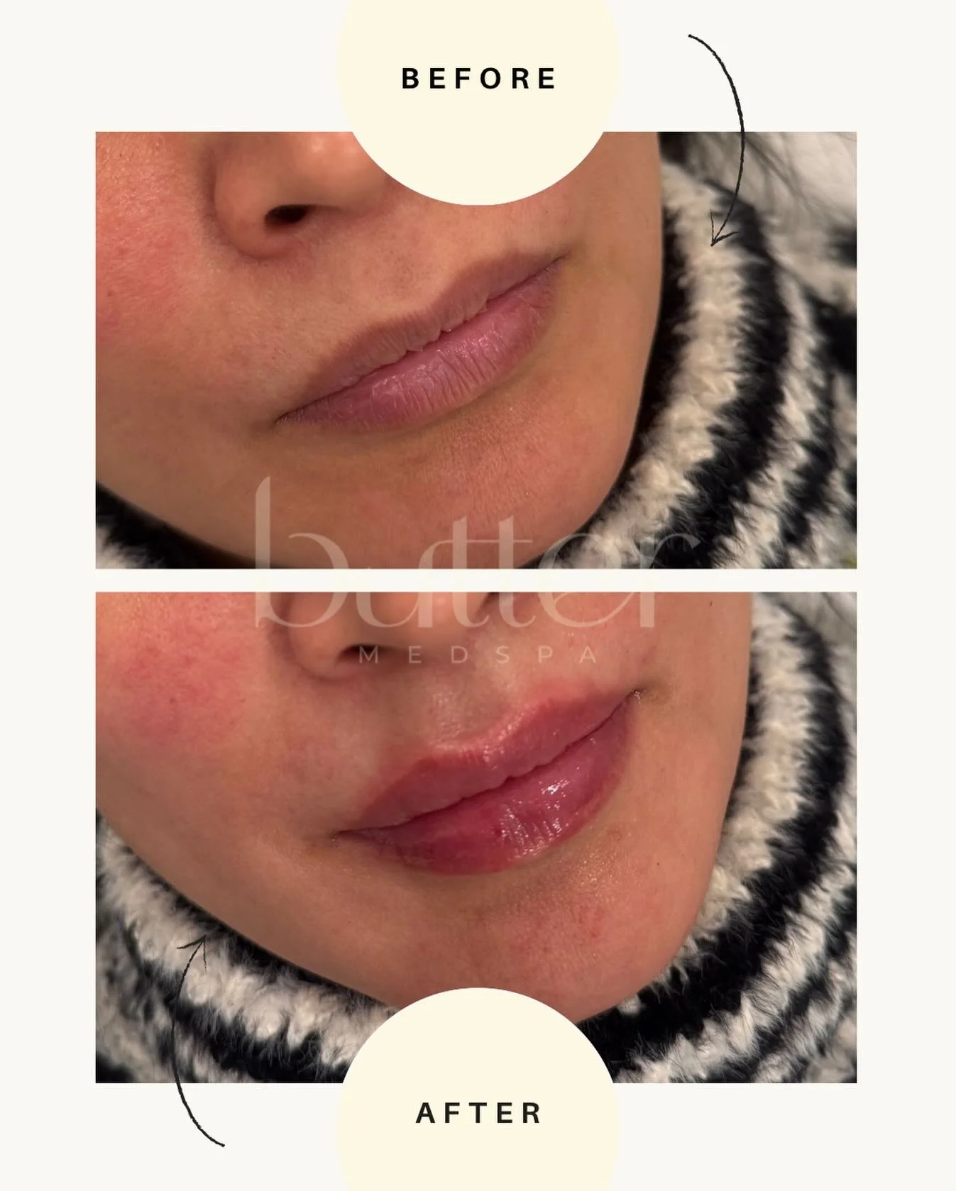 Soft, hydrated, and perfectly balanced. 
Ehanced shape, smoother texture, and a juicy finish without looking overdone.

💋 Valentine&rsquo;s Day Special
Join us Feb 6 &amp; 7 and get a Full Butter Kiss (1 mL lip filler) for 20% off&mdash;the perfect 