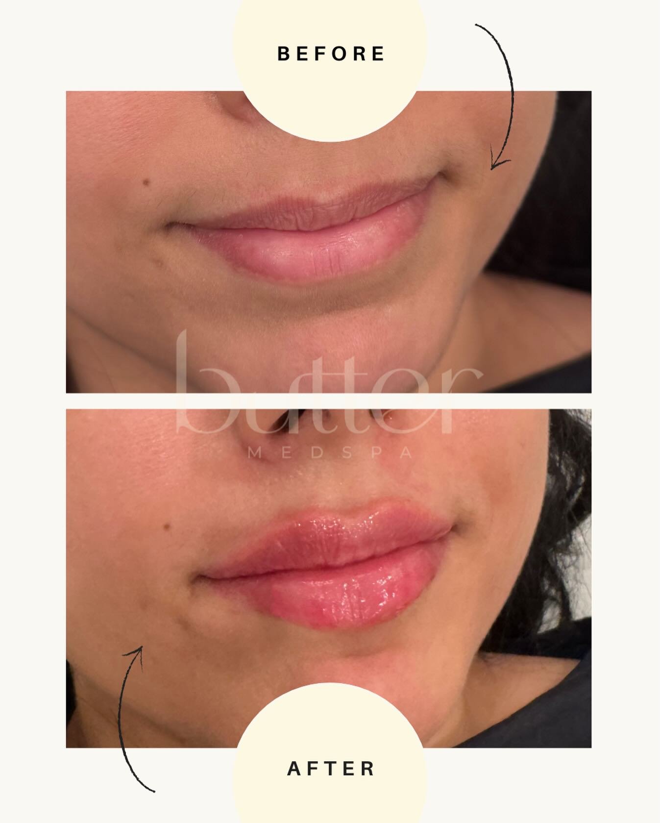 This subtle lip enhancement adds hydration, shape, and balance while still looking like you&mdash;never overdone.

✨ Valentine&rsquo;s Day Special | Feb 6 &amp; 7
&bull; Full syringe lip filler $560
&bull; Expert facial assessment + customized plan
&