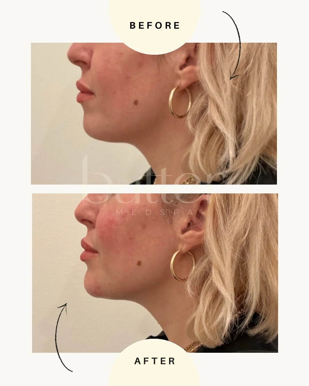 She came in for facial balancing.
She left looking harmonized.

Strategic chin and midface filler restored structure, improved projection, and brought her features into proportion.

This isn&rsquo;t about adding volume.
It&rsquo;s about creating bala
