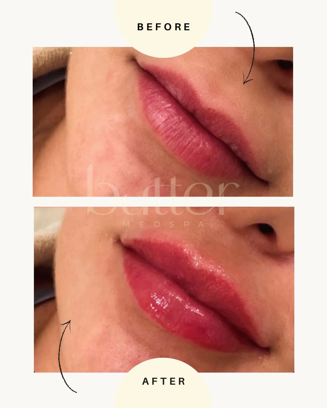 In her &ldquo;soft launch new lips&rdquo; era 💛

This Full Butter Kiss (1 mL) added structure, subtle projection, and a smoother finish without changing her natural shape.

Facial balancing always. Overdone never.

Book online &mdash; ButterMedspa.c