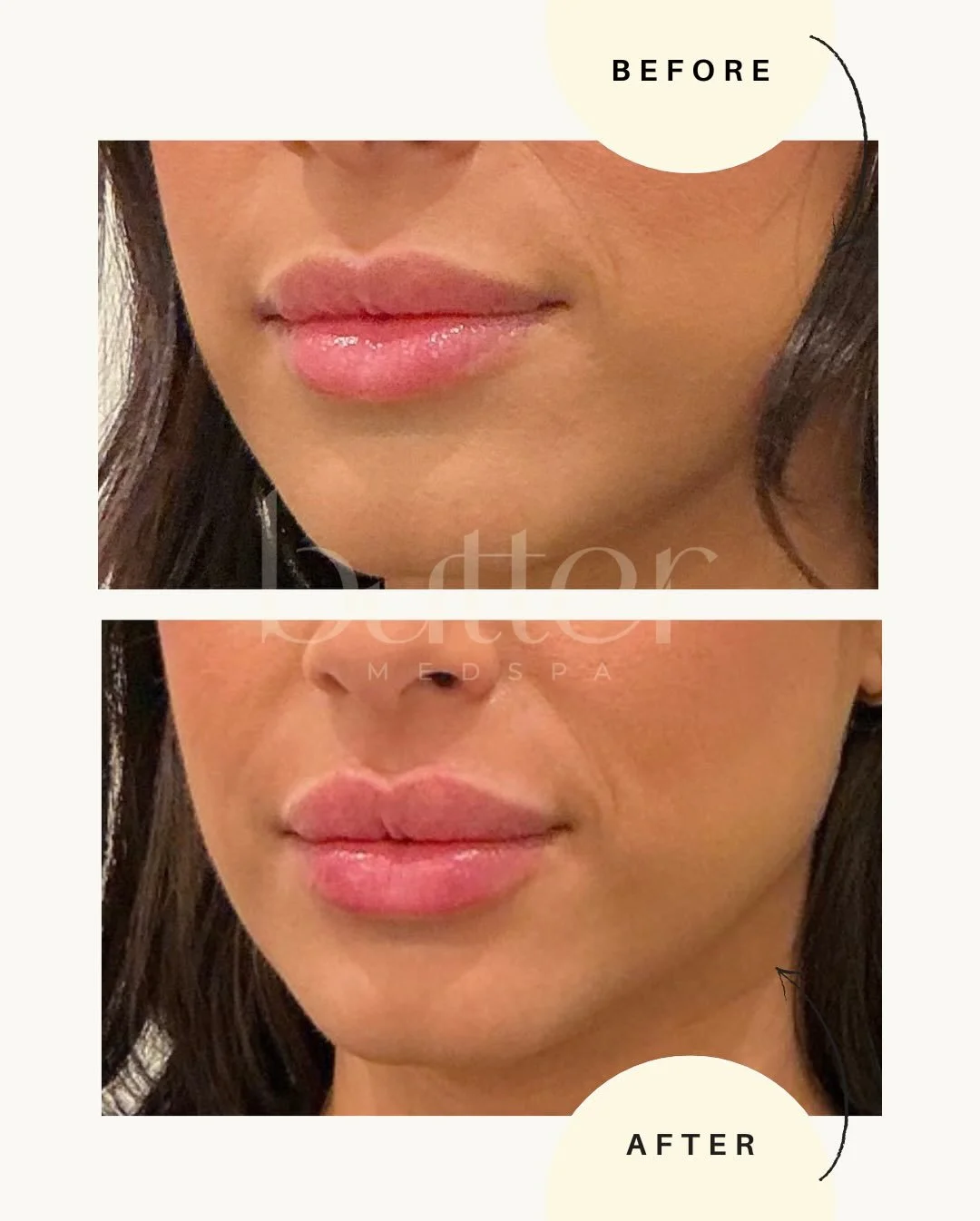 Full Butter Kiss 💋 (1 mL)

Our beautiful client already had naturally full lips &mdash; she just wanted a refresh.

Notice the difference:
&bull; Improved symmetry
&bull; More defined cupid&rsquo;s bow
&bull; Added softness with subtle structure
&bu