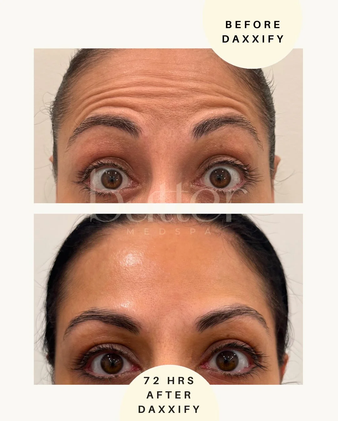 Daxxify has officially arrived at Butter ✨

What makes it different? Daxxify is a wrinkle-relaxing tox (like Botox) that softens lines, and is formulated with a proprietary peptide, designed for extended results. 

Why clients are choosing it:

&bull