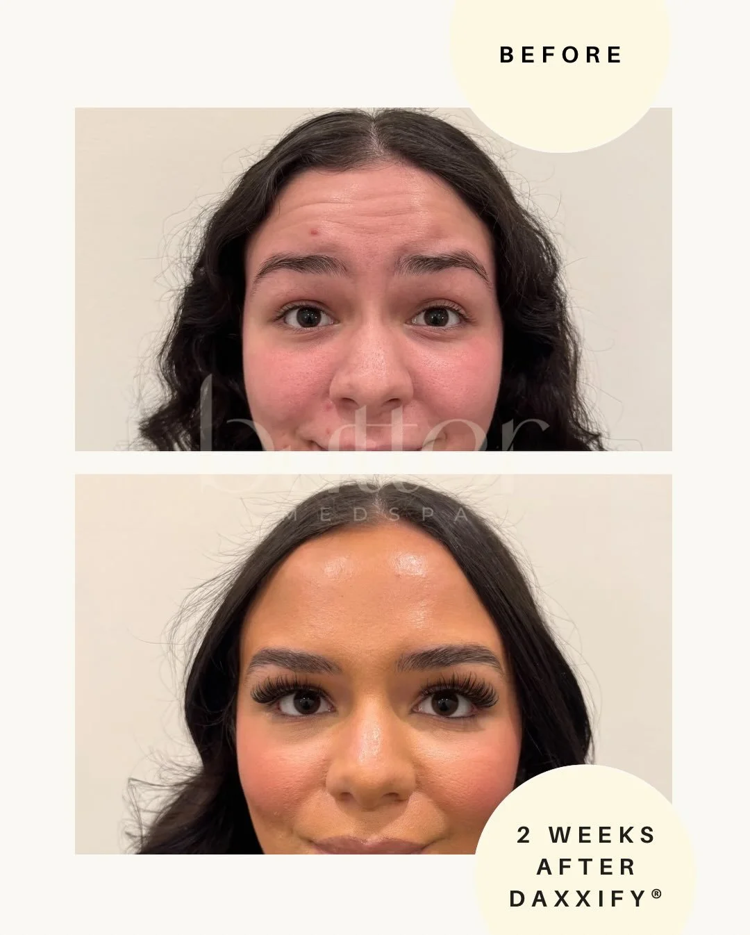 Smooth. Lifted. Glowing. ✨

These results are just 2 weeks after Daxxify&reg; &mdash; a next-generation neurotoxin designed to smooth lines and leave skin looking refreshed and radiant.

Want to experience this glow for yourself?

Join us for our Dax