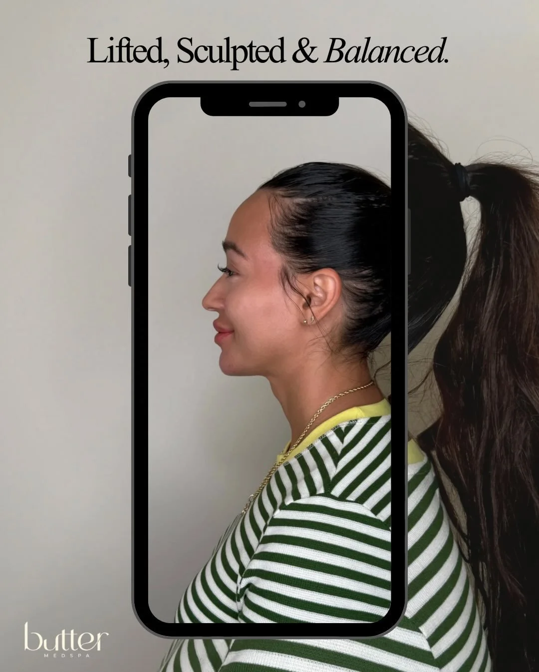 SWIPE TO SEE THIS FACIAL HARMONY TRANSFORMATION ➡️

When it comes to facial balancing, it&rsquo;s not about changing your features, it&rsquo;s about enhancing them in a way that creates harmony, proportion, and confidence.

For this beautiful patient