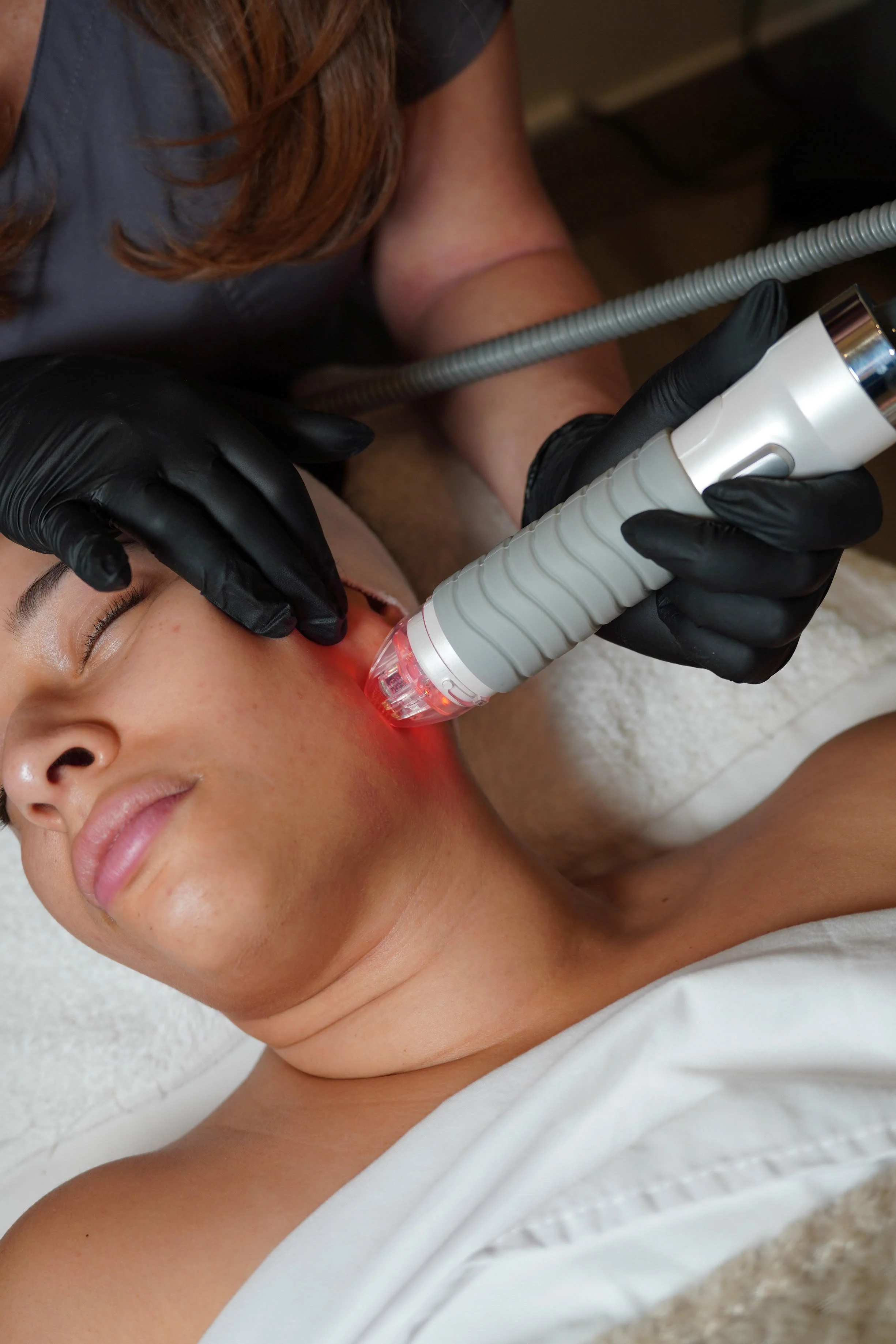 A woman receiving a laser skin treatment on her face while lying down. She has closed eyes, and a technician wearing black gloves is holding the laser device.